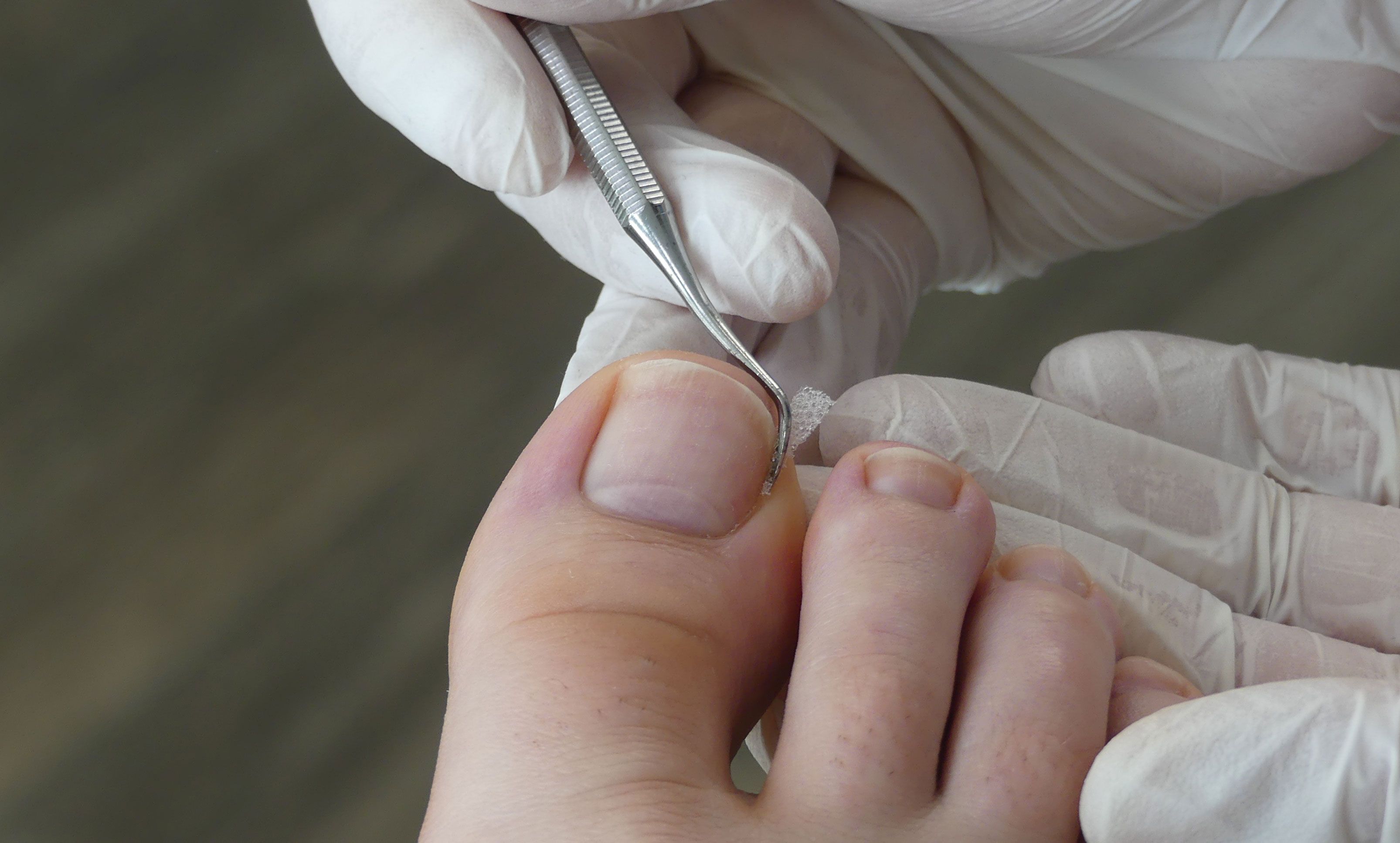 Voet met ingegroeide teennagel. Gehandschoende handen gebruiken een instrument.