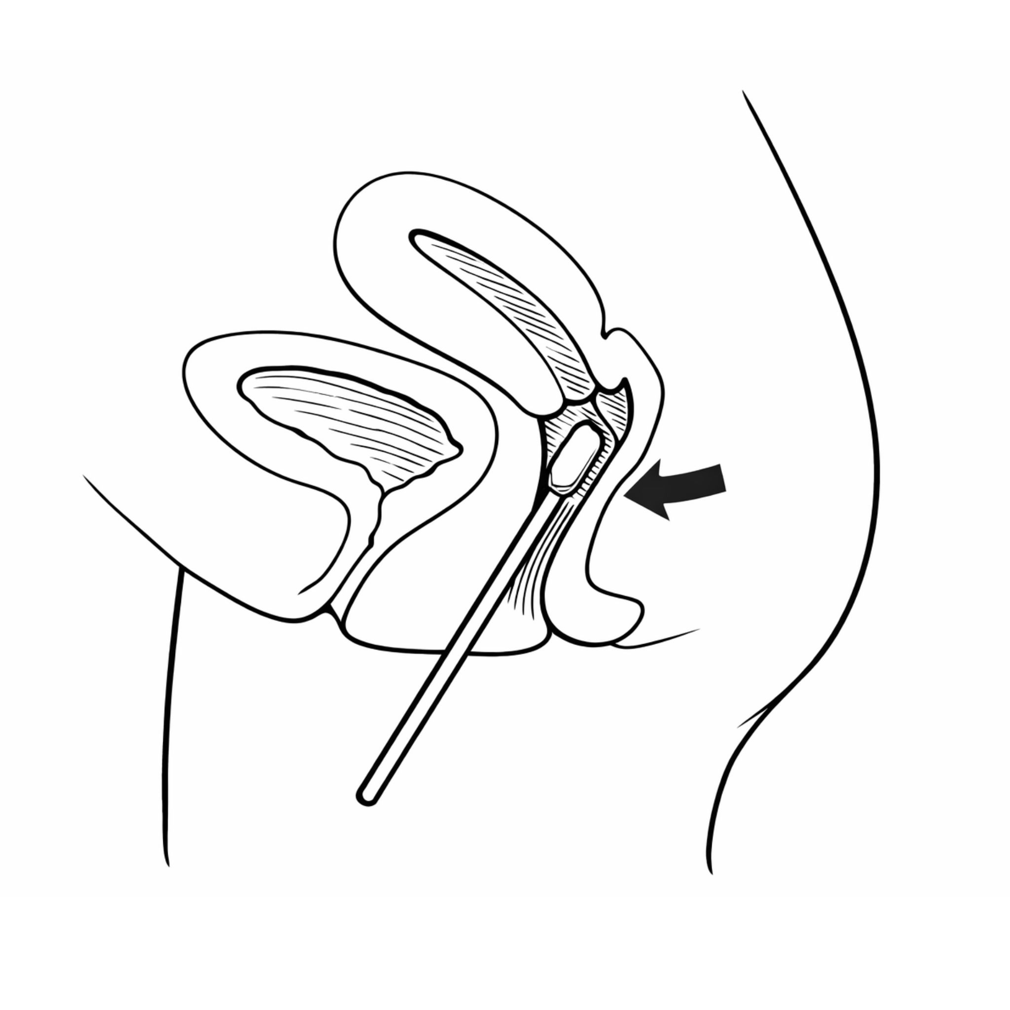 Horny Hive Chlamydien und vaginaler pH