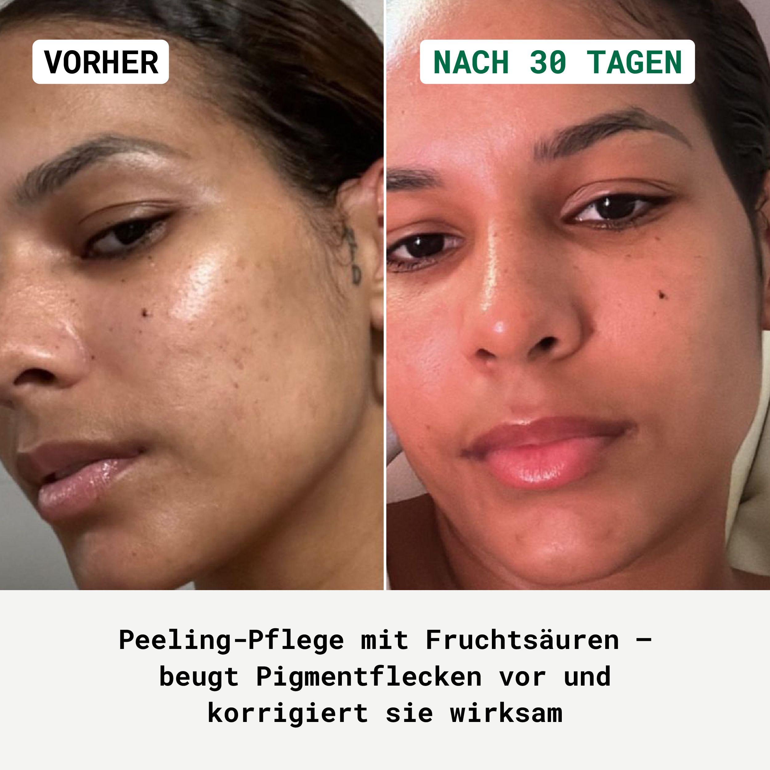 Vorher-Nachher-Vergleich. Gesicht mit Pigmentflecken, dann ebenmäßiger Teint. Text: Peeling-Pflege beugt Pigmentflecken vor.