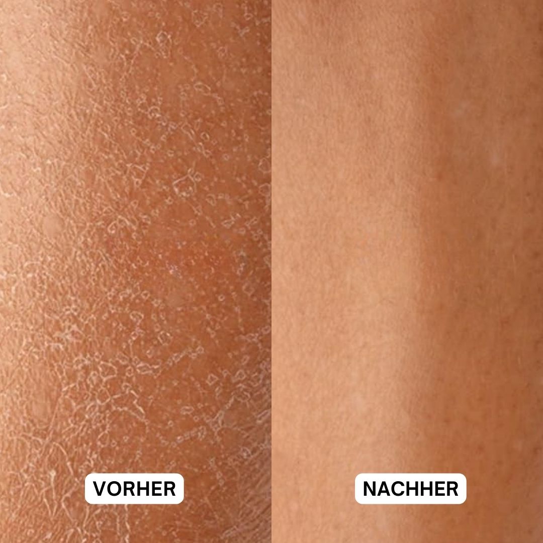 Haut vor und nach der Anwendung. Vorher: trockene Haut. Nachher: glatte Haut.
