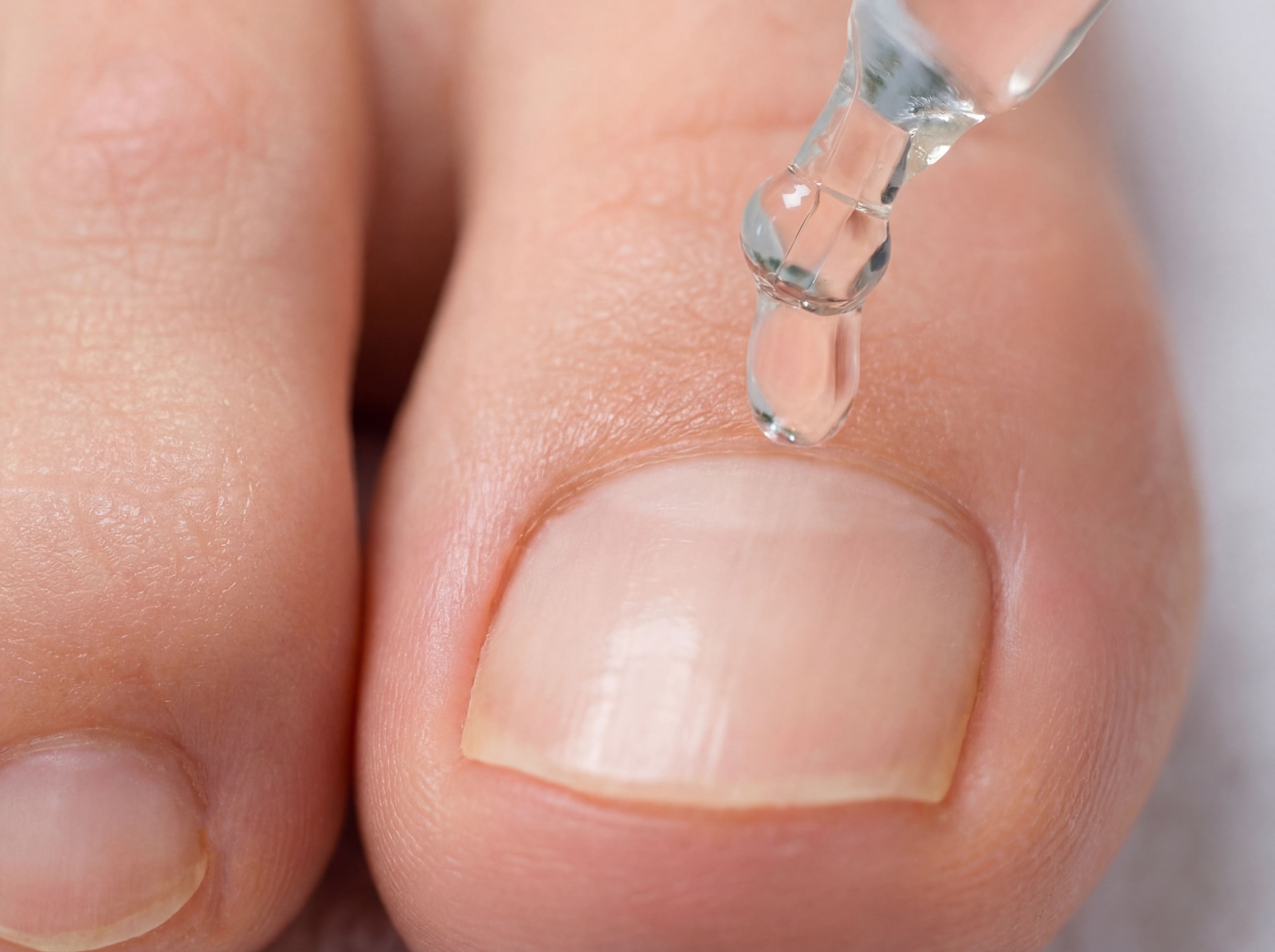 Nahaufnahme: Pipette tropft MALUFIN Nagelbalsam auf einen Zehennagel.