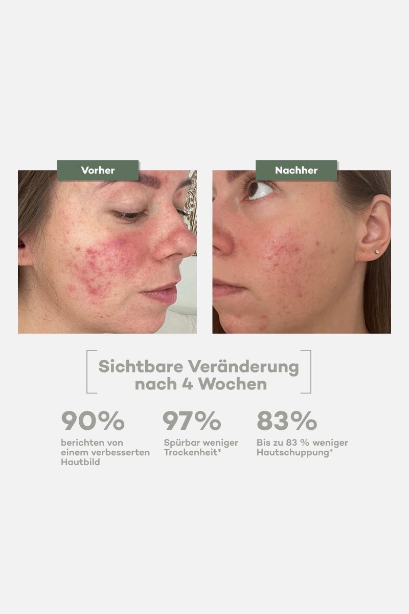 Tallow Barrier Repair Pur – Creme bei Neurodermitis, Ekzem & Psoriasis – Bio Rindertalg (120ml)