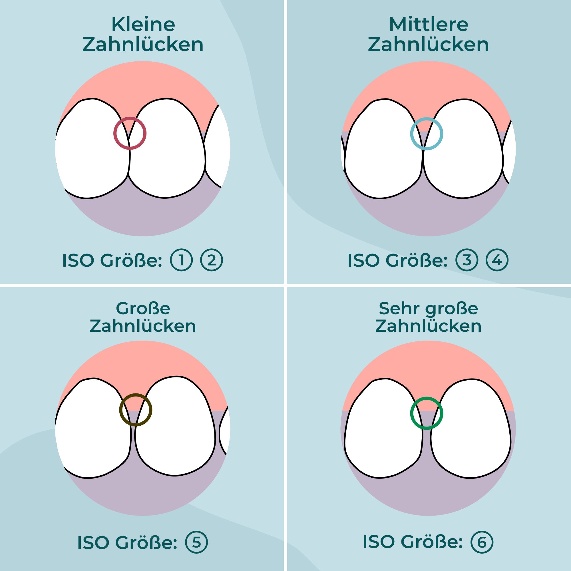 Grafik mit vier Illustrationen von Zähnen. Text: Kleine, mittlere, große, sehr große Zahnlücken. ISO Größe: 1-6.