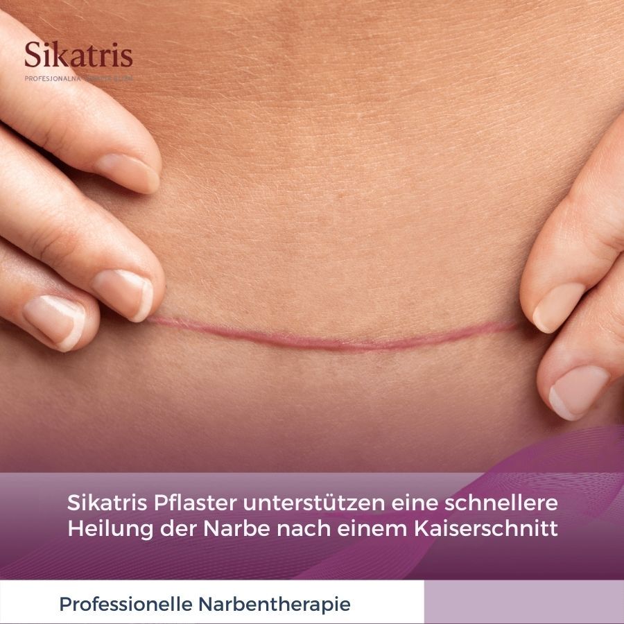 Nahaufnahme eines Bauches mit einer Narbe. Text: 'Sikatris Pflaster unterstützen eine schnellere Heilung der Narbe nach einem Kaiserschnitt'.