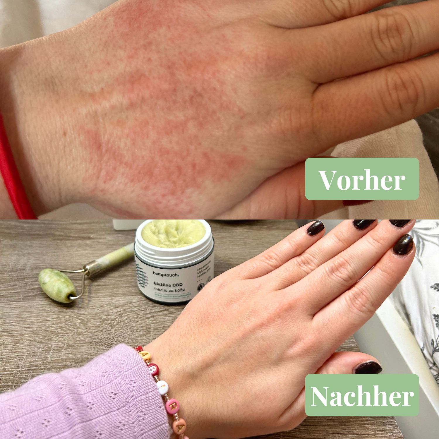 Hände mit Hautausschlag (Vorher) und gesunde Hände (Nachher). Daneben Tiegel Hemptouch Beruhigender CBD Hautbalsam.