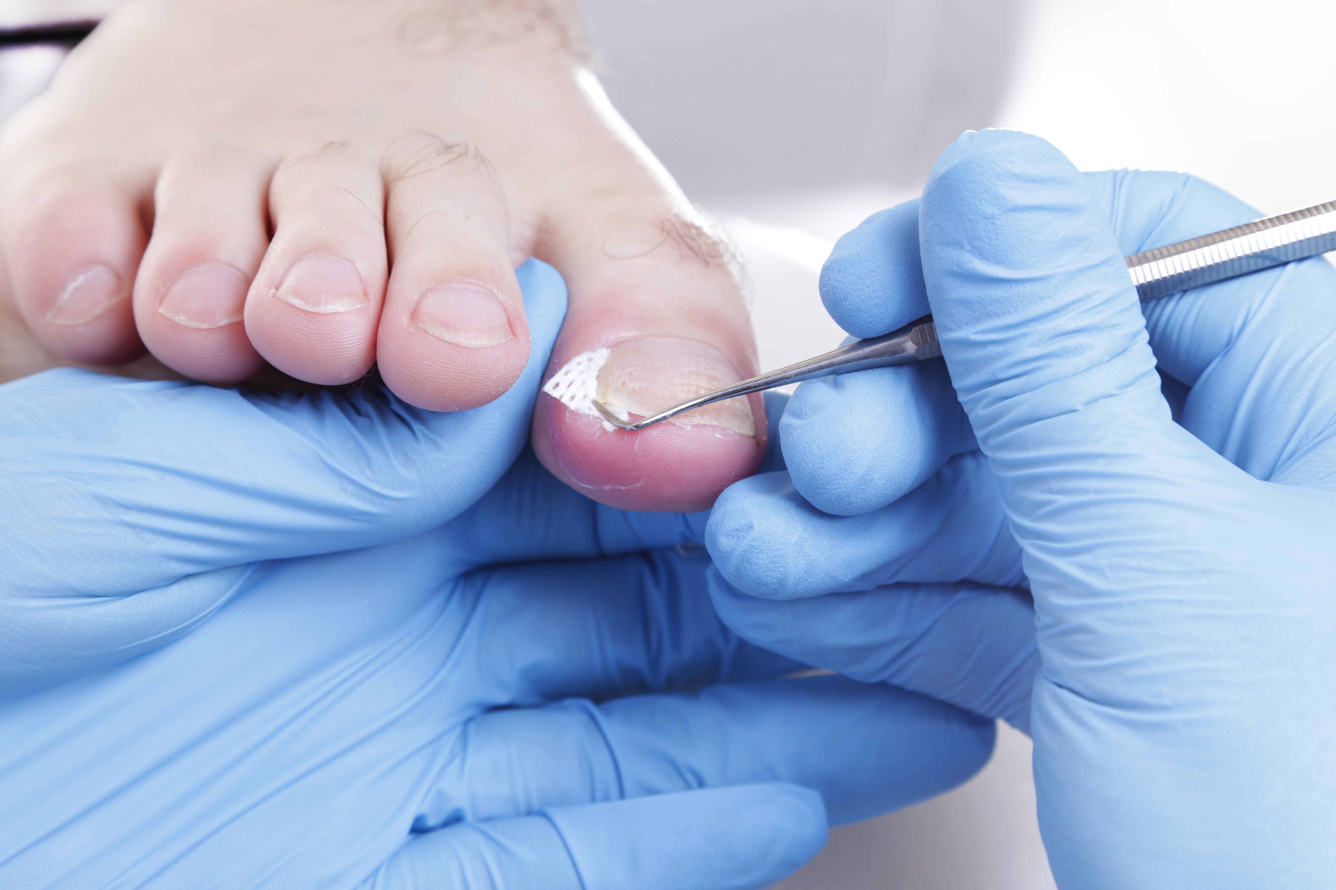 Voet behandeld met K-Pro Eckenheber. Handen met blauwe handschoenen. Instrument in gebruik.