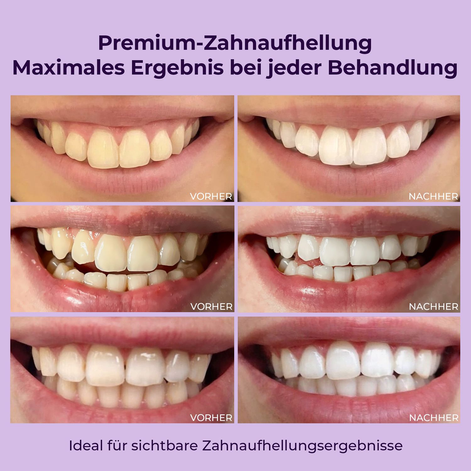 Vorher-Nachher-Bilder von Zähnen. Zeigt Ergebnisse der Zahnaufhellung. Ideal für sichtbare Ergebnisse.