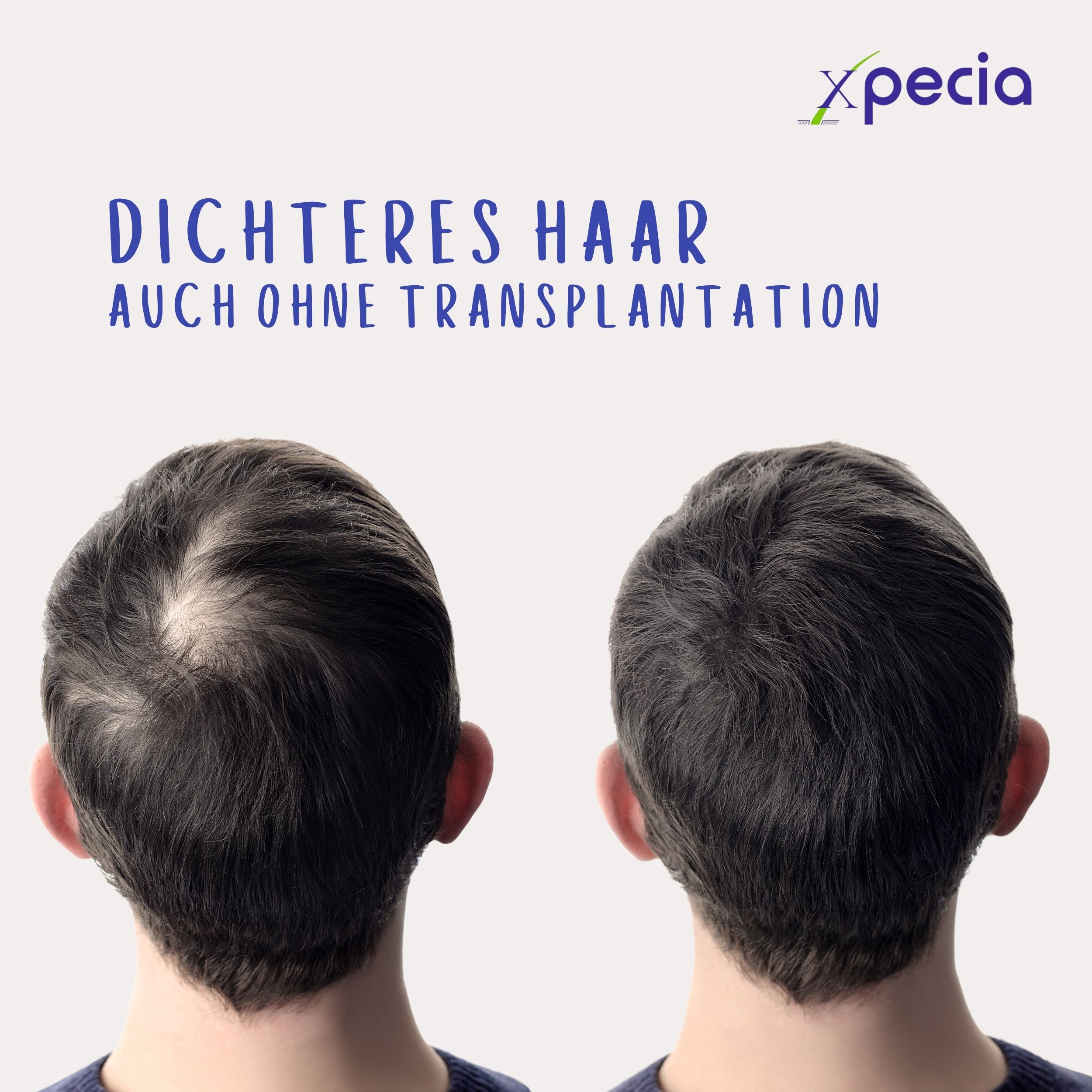 Zwei Männer mit Haarausfall. Text: Dichteres Haar auch ohne Transplantation.