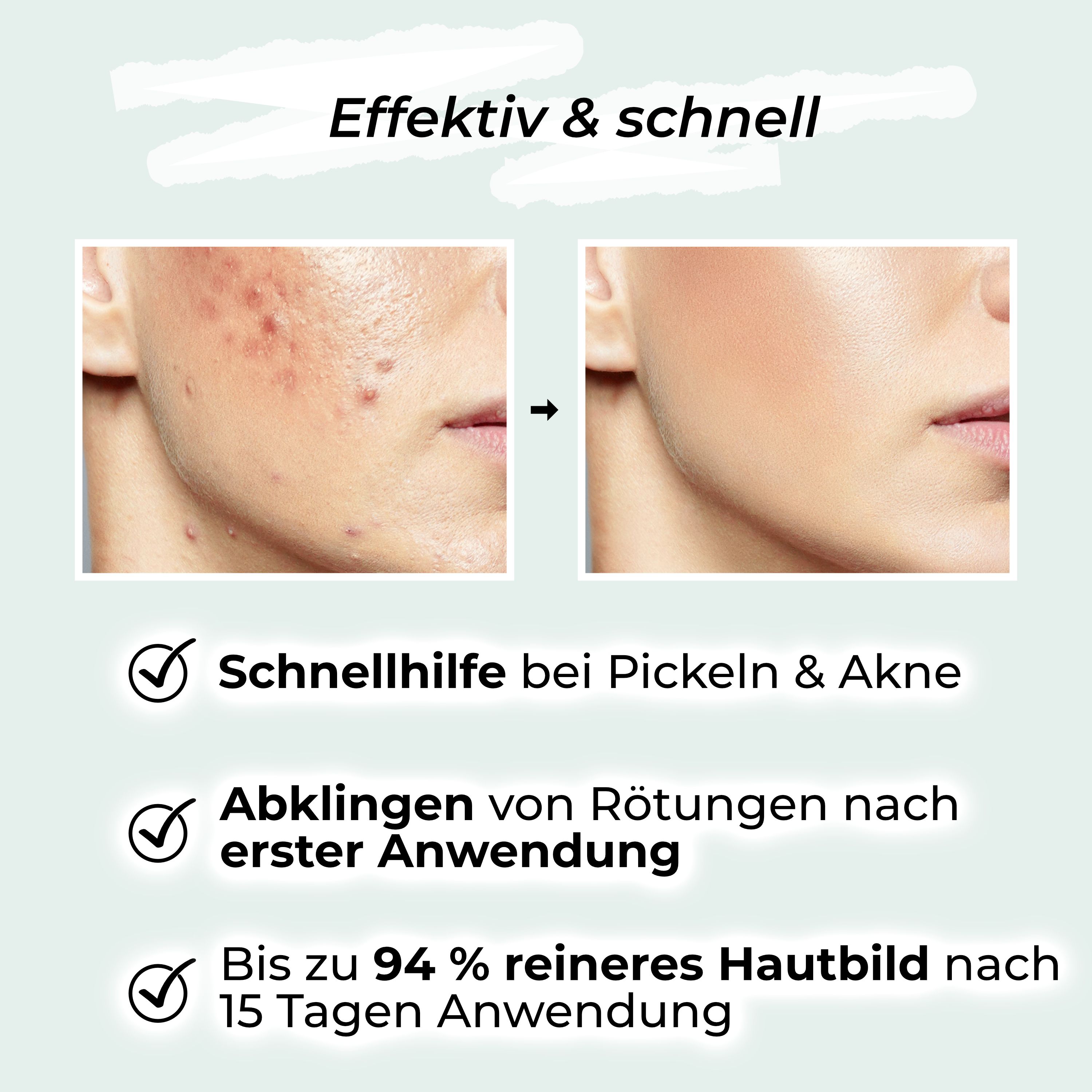 Vorher-Nachher-Vergleich: Haut mit Pickeln, dann klare Haut. Text: Schnellhilfe bei Pickeln & Akne, Rötungen, reineres Hautbild.