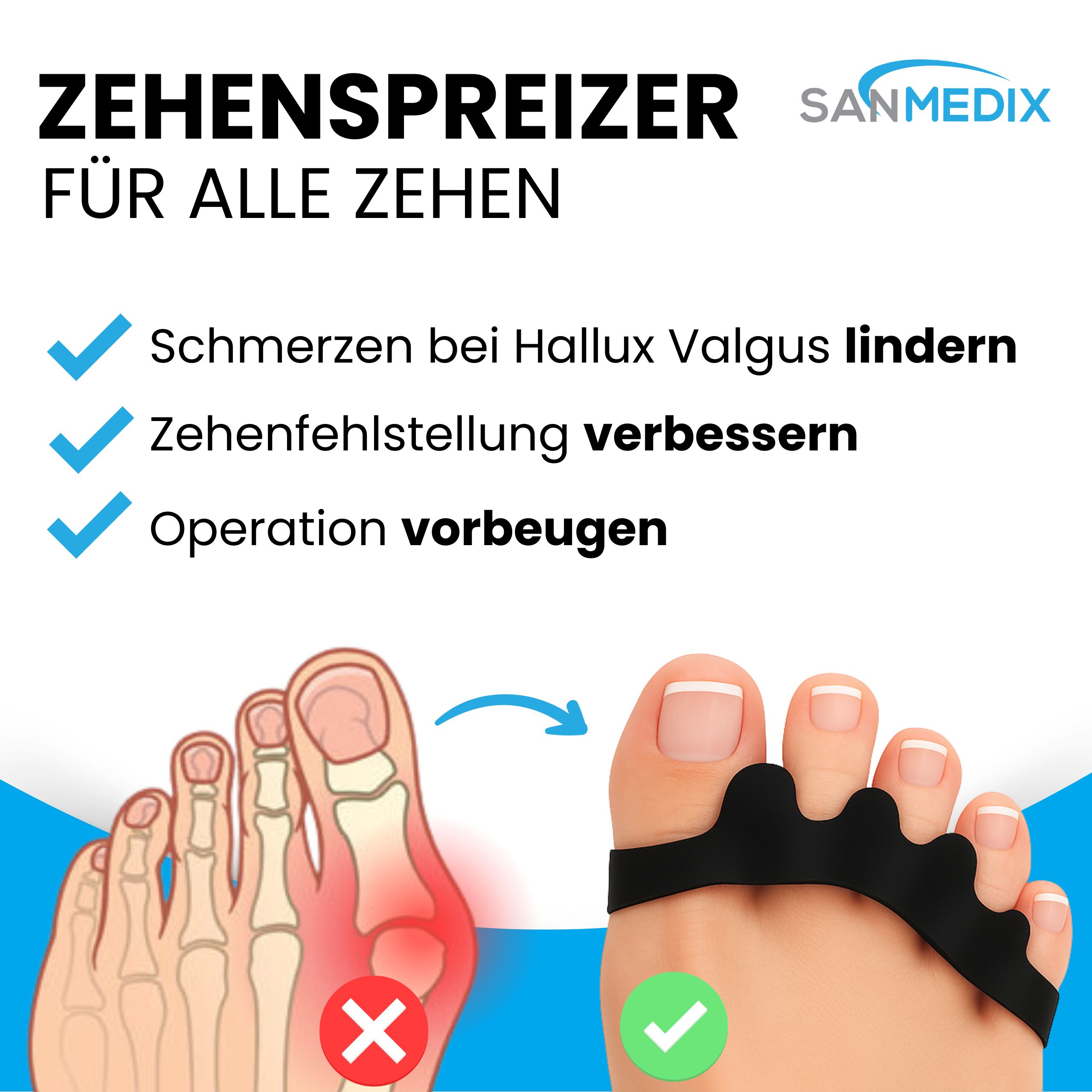 Sanmedix Zehenspreizer: Lindert Hallux Valgus Schmerzen, verbessert Zehenfehlstellung. Zeigt Vorher-Nachher-Vergleich.