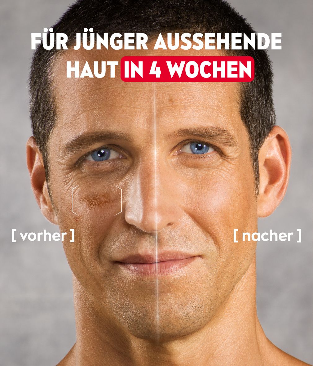 Vorher-Nachher-Vergleich. Mann mit Hautunreinheiten. Nach 4 Wochen jünger aussehende Haut.