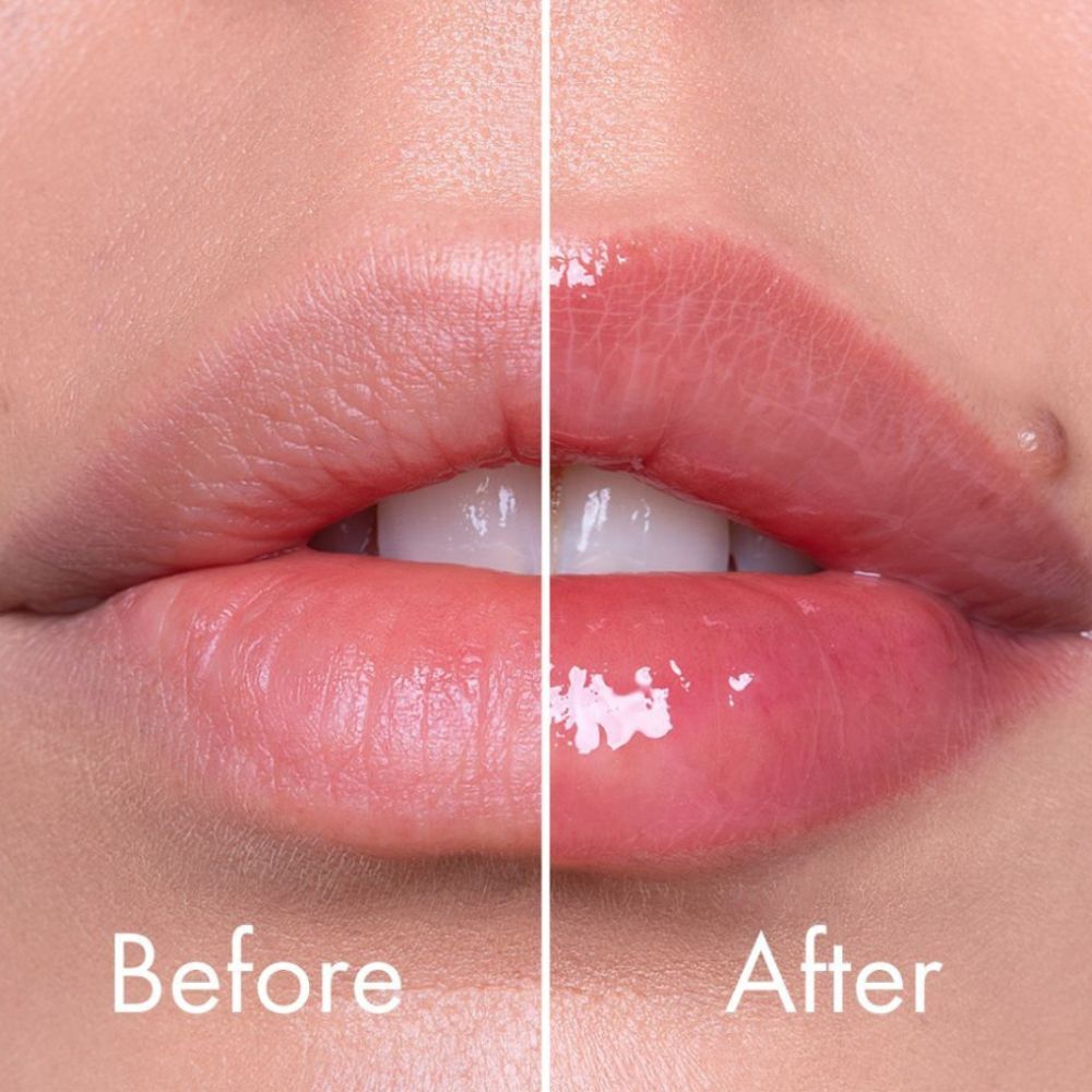 Vorher-Nachher-Vergleich von Lippen, die mit einem Lippenplumper behandelt wurden.