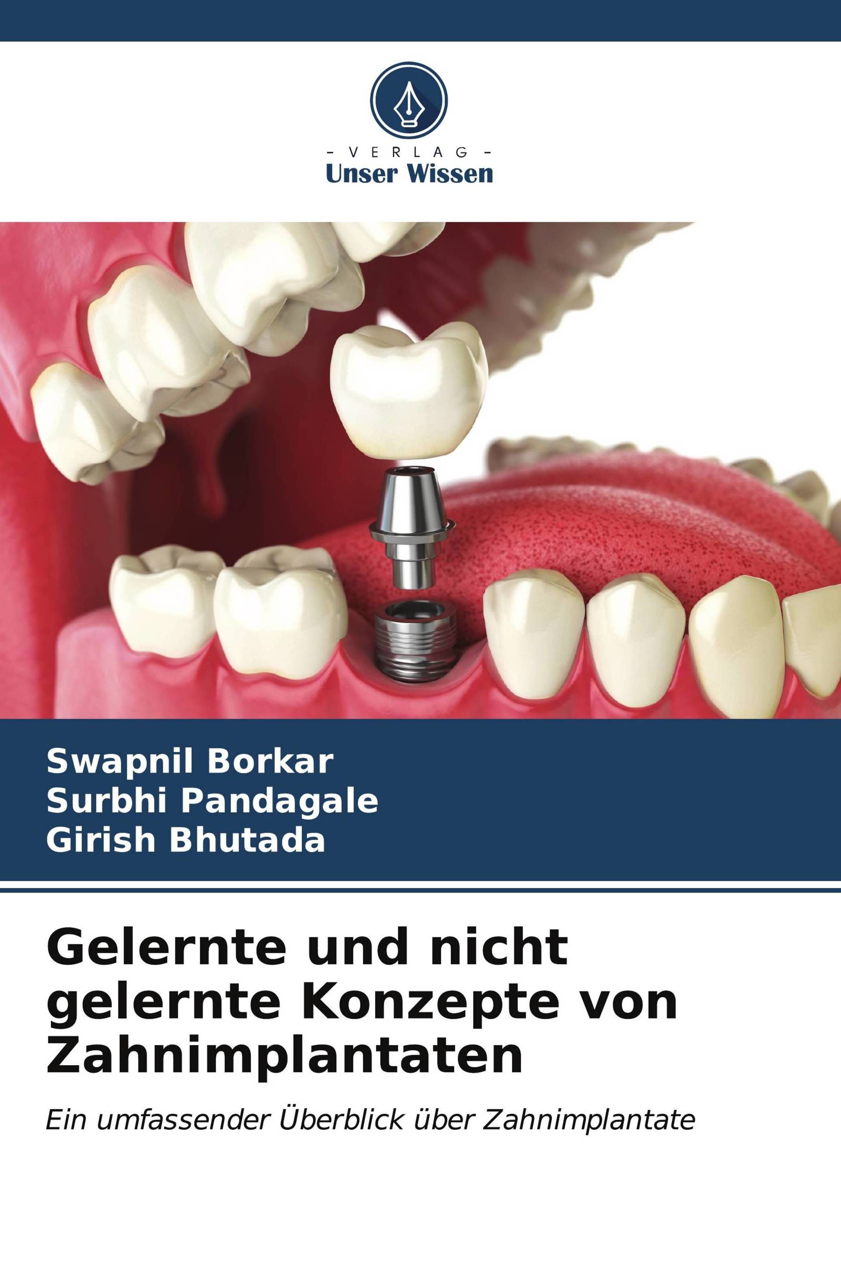 Gelernte und nicht gelernte Konzepte von Zahnimplantaten Ein umfassender Überblick über Zahnimpla...