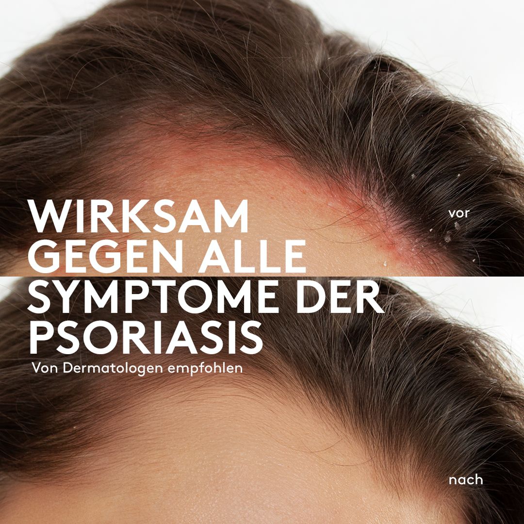 Sphagnum Botanicals Psoriasis Shampoo - mit Salicylsäure & Panthenol