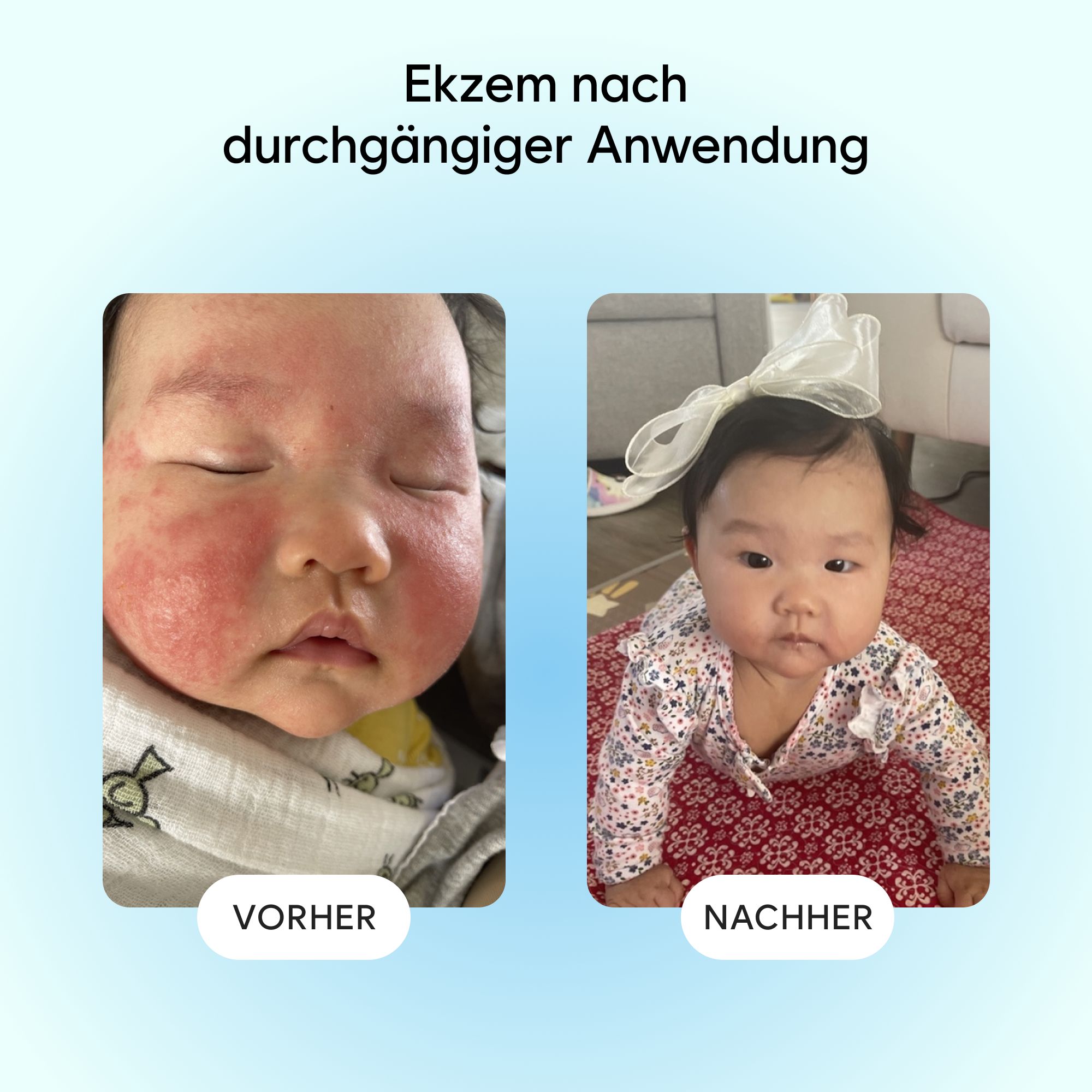 Gladskin Eczemact Gel