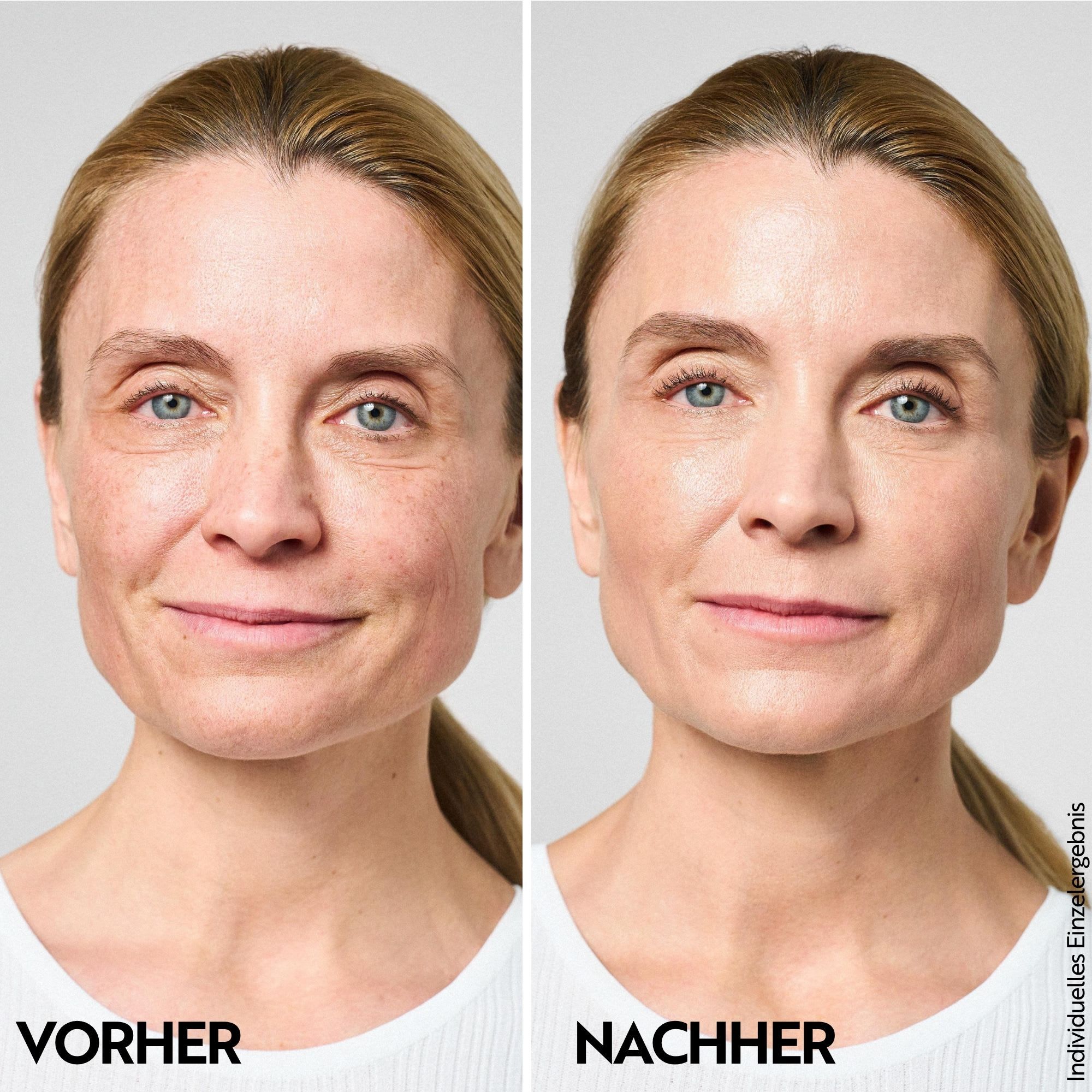Vorher-Nachher-Vergleich einer Frau, die das M. Asam Aqua Intense Mimic Booster Serum verwendet.
