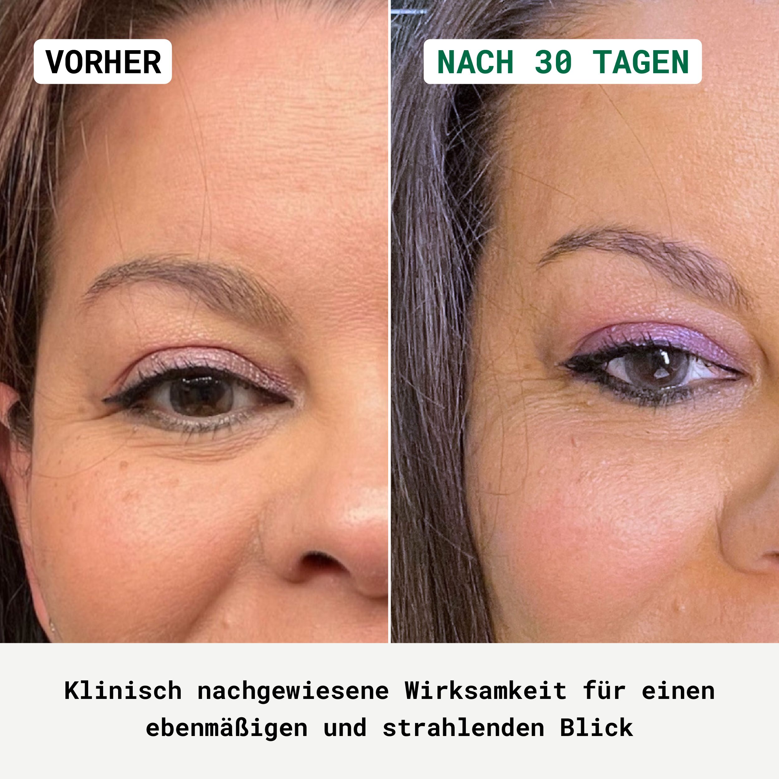 Vorher-Nachher-Vergleich. Augenpartie mit Falten. Nach 30 Tagen weniger Falten.