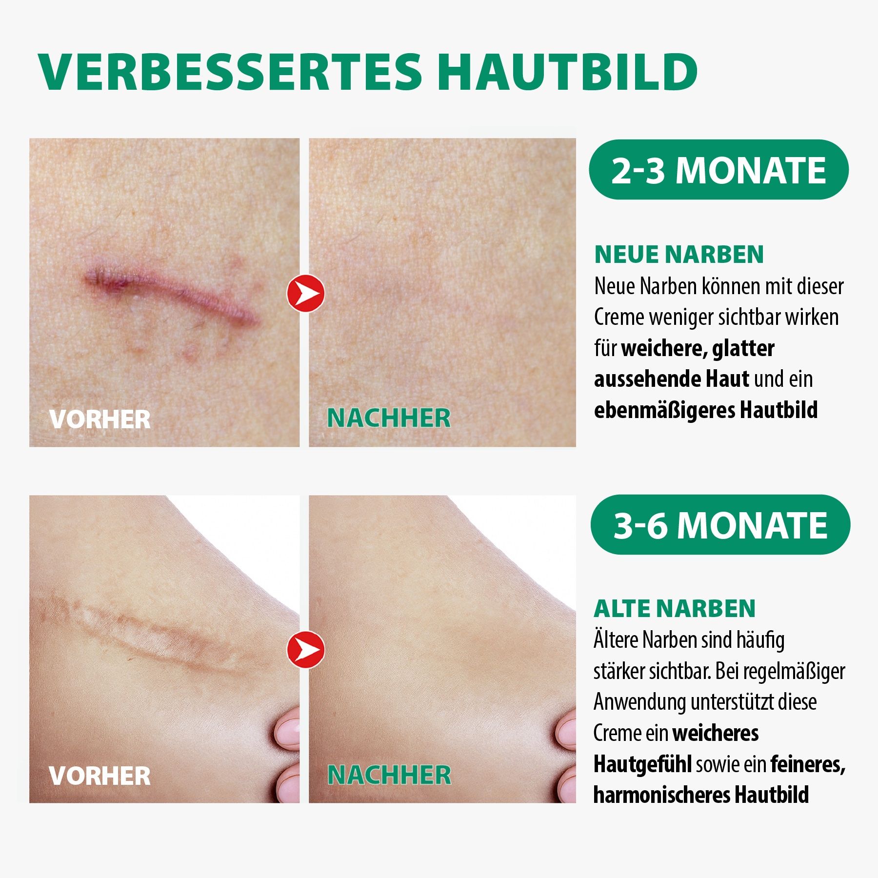 Vorher-Nachher-Bilder von Narben. Text: Verbessertes Hautbild. Neue und alte Narben. 2-3 und 3-6 Monate.