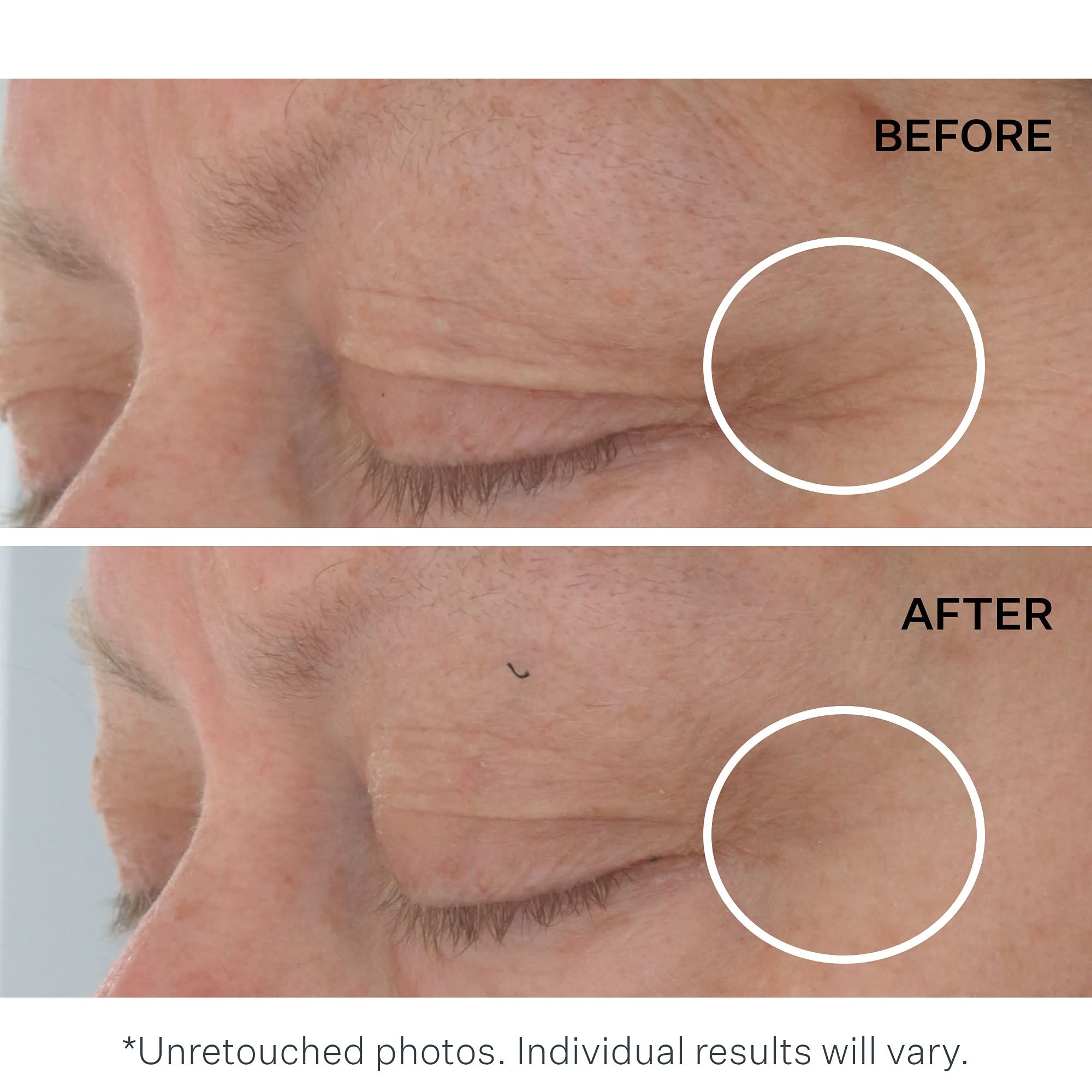 Vorher-Nachher-Bild von Augenpartien. Kreise markieren Bereiche. Text: Unretouched photos. Individual results will vary.