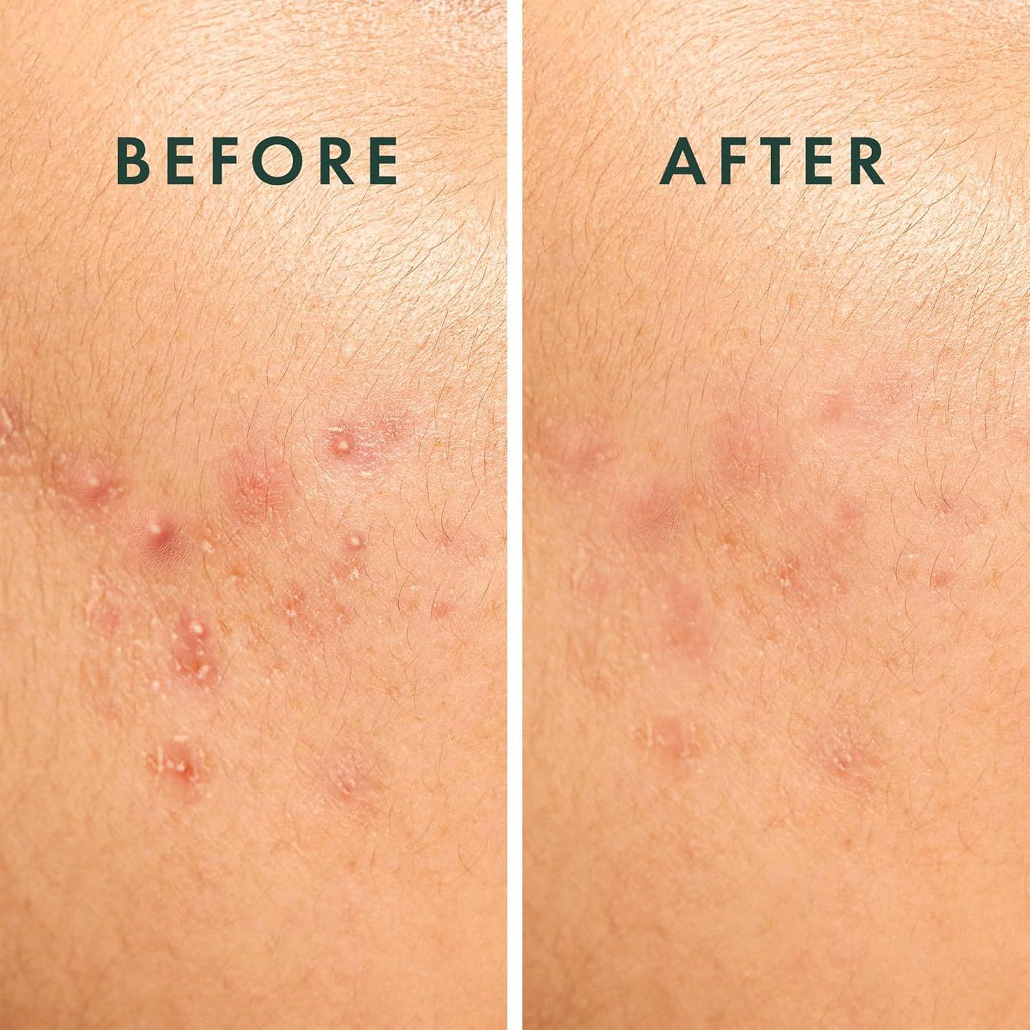 Zwei Nahaufnahmen von Hautpartien. Links: Haut mit Pickeln. Rechts: Haut nach Behandlung, weniger Pickel.