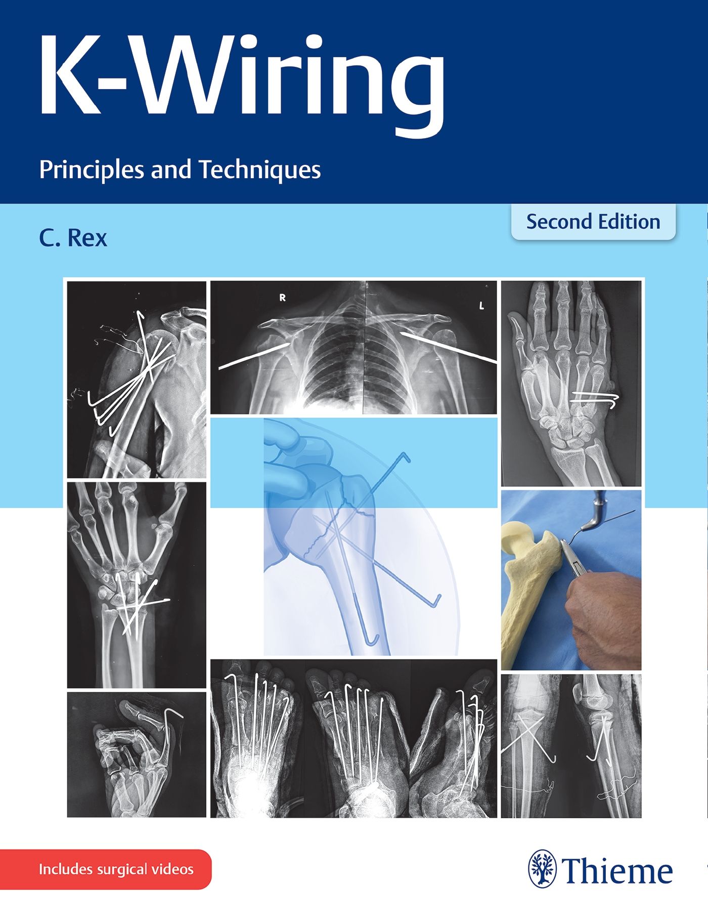 Buchcover: K-Wiring, Prinzipien und Techniken. Röntgenbilder von Knochen mit Drähten. Zweite Auflage. Verlag Thieme.