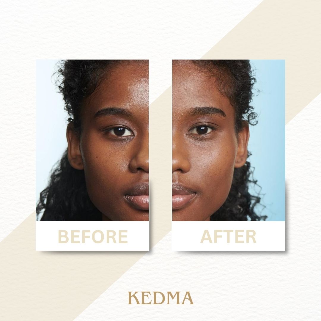 Voor-en-na vergelijking. Gezichtshelften van een persoon. Links: Voor. Rechts: Na. Kedma logo.
