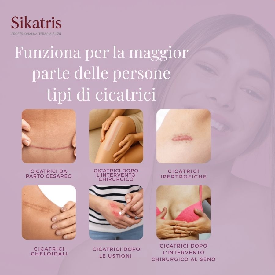 Grafik mit Beispielen für Narbenarten. Text in italienischer Sprache. Abbildungen von Narben auf Haut.