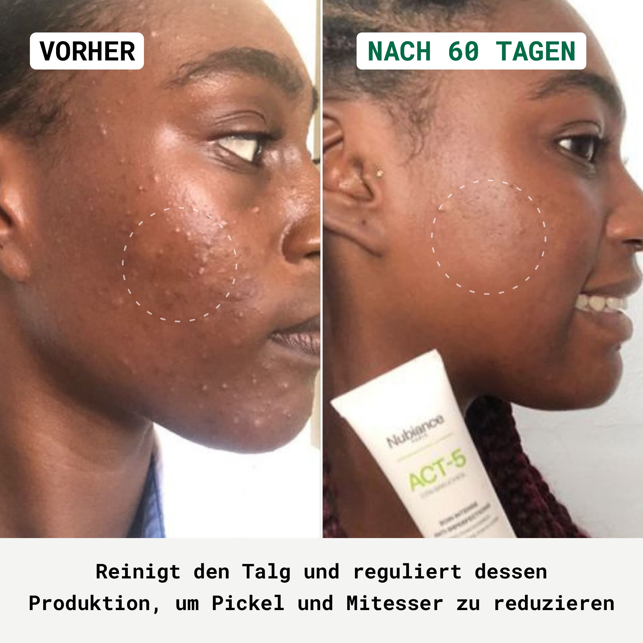 Vorher-Nachher-Vergleich. Gesicht mit Unreinheiten, dann gereinigtes Gesicht. Produkt-Tube sichtbar.