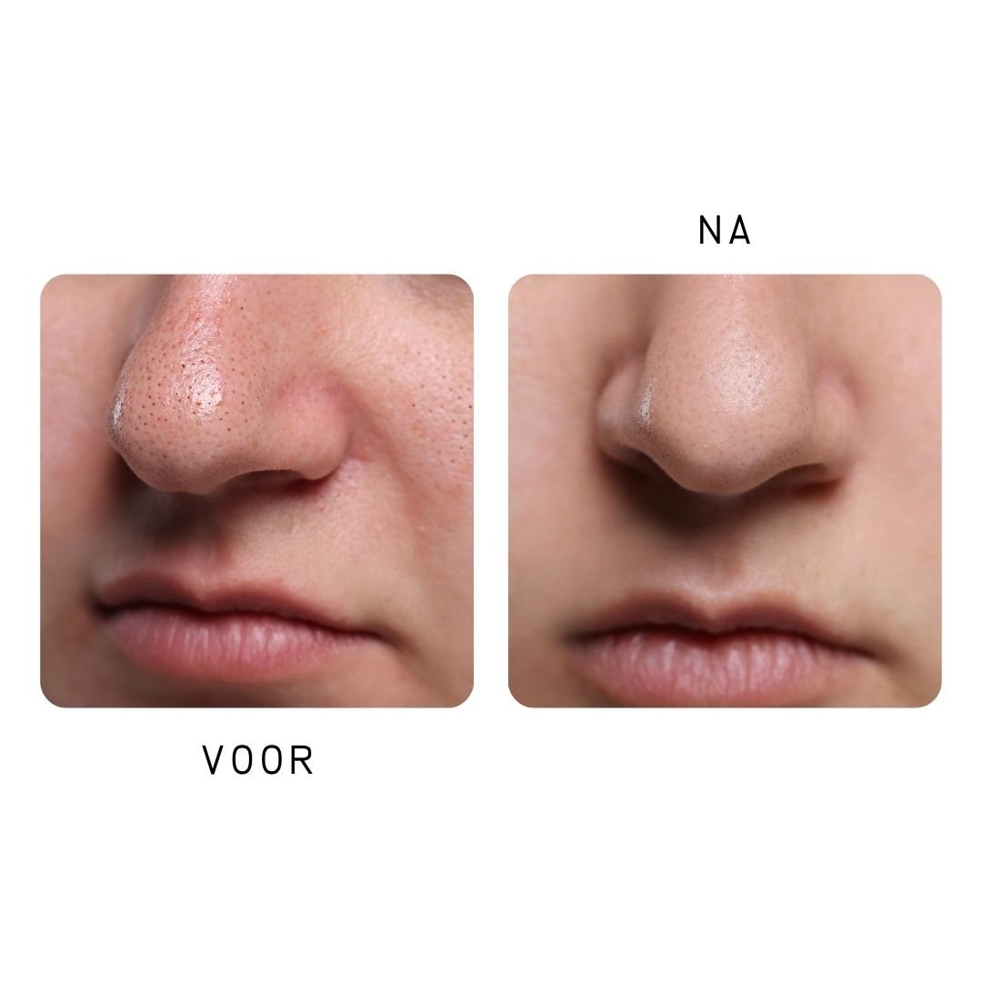 Twee close-ups van neuzen. Links: Voor, met poriën. Rechts: Na, gladde huid.