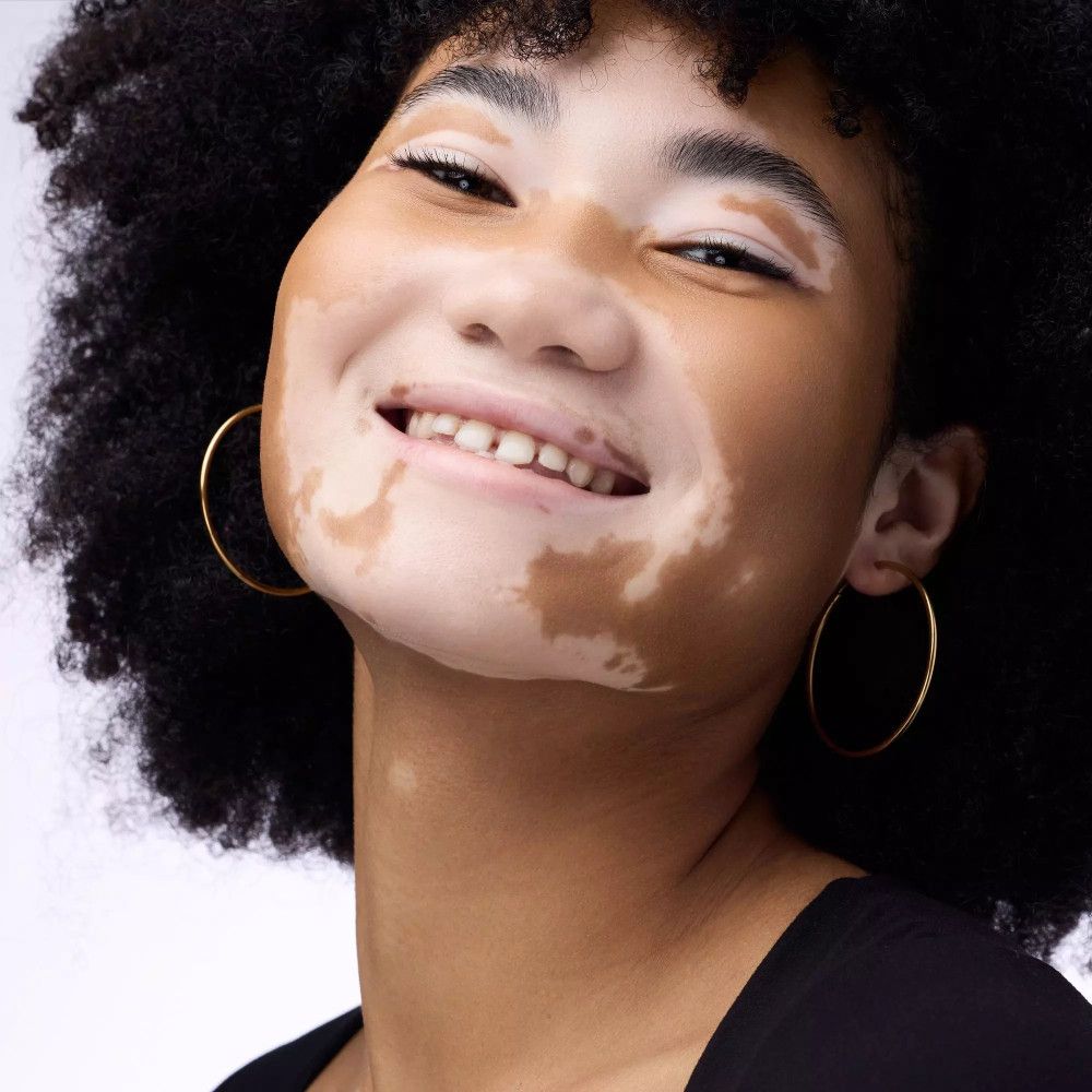 Porträt einer Frau mit Vitiligo. Sie lächelt. Hautton: hell. Hintergrund: hell.