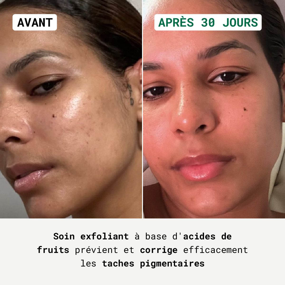 Vorher-Nachher-Vergleich. Gesicht mit Pigmentflecken, dann ebenmäßiger Teint. Text: Exfolierende Pflege beugt Pigmentflecken vor.