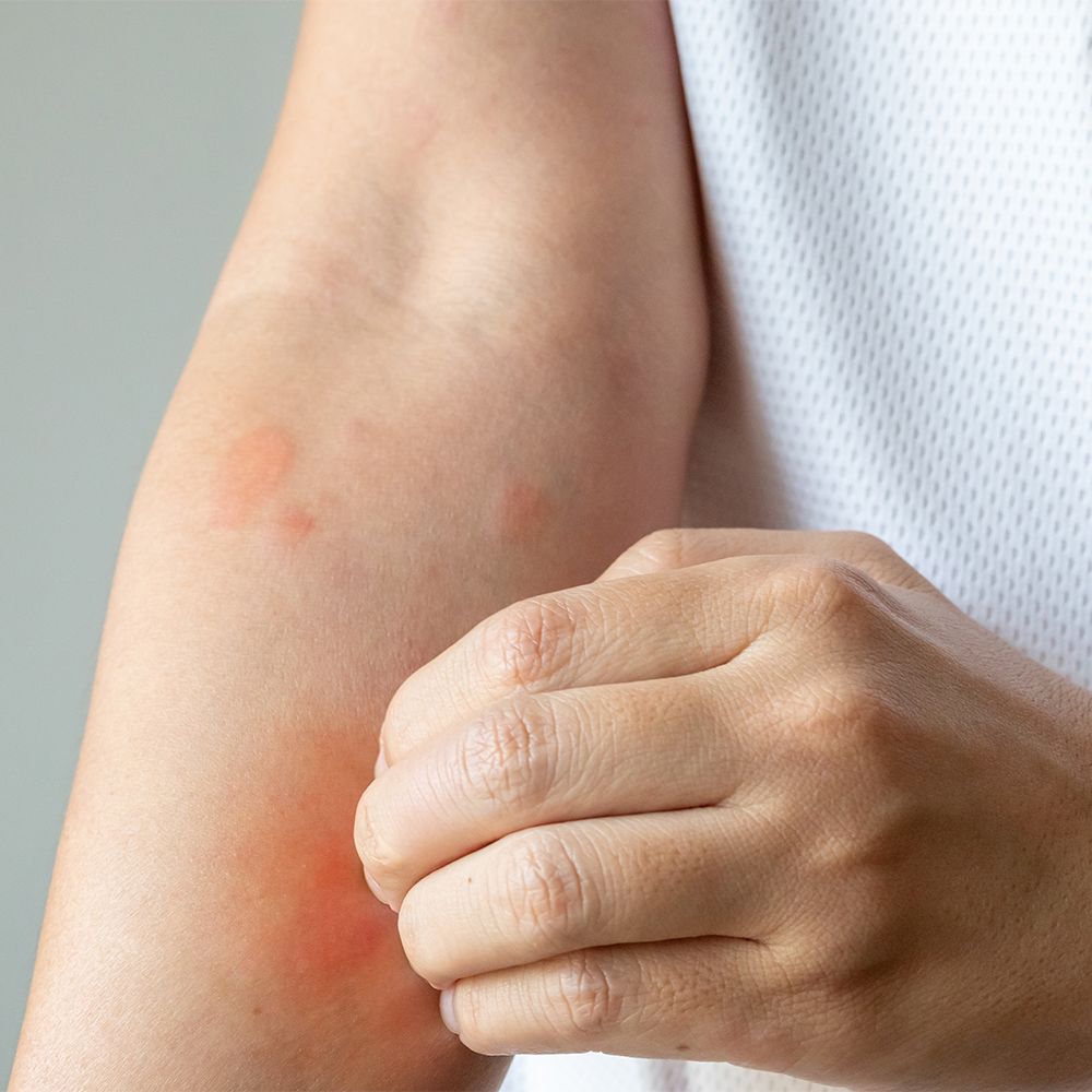 Close-up van een arm met rode, jeukende huiduitslag. Een hand raakt het getroffen gebied aan.
