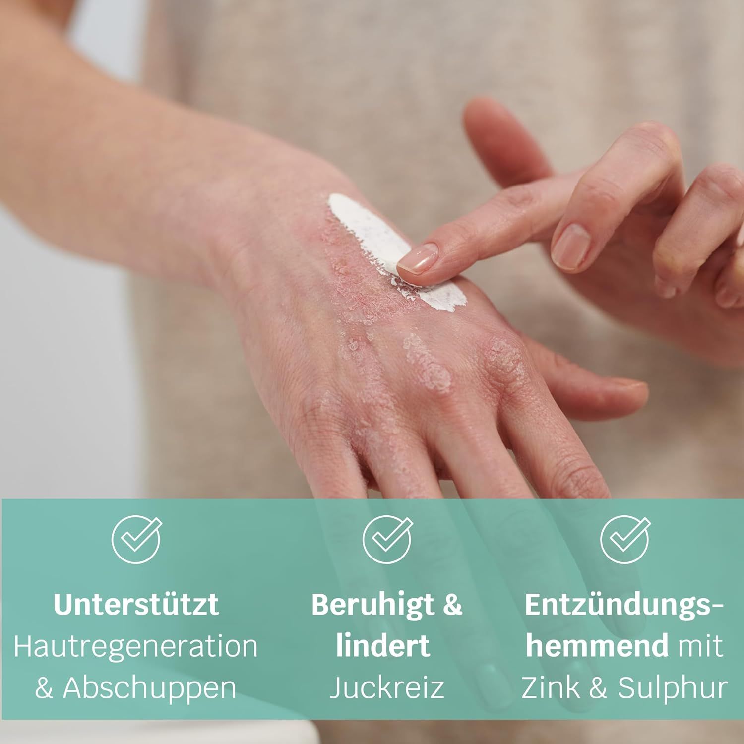 Hand mit Creme auf Hautpartie. Text: Unterstützt Hautregeneration, beruhigt Juckreiz, entzündungshemmend mit Zink & Sulphur.