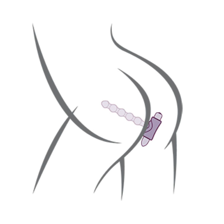 Schematische Darstellung eines Analplugs im Körper. Lila dargestellt.
