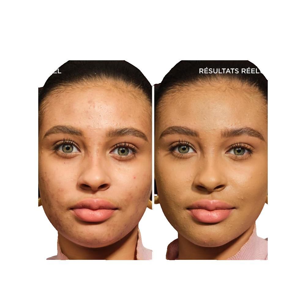 Vorher-Nachher-Vergleich. Gesicht mit Hautunreinheiten, dann Gesicht mit ebenmäßigem Teint. Text: 'Résultats réel'.