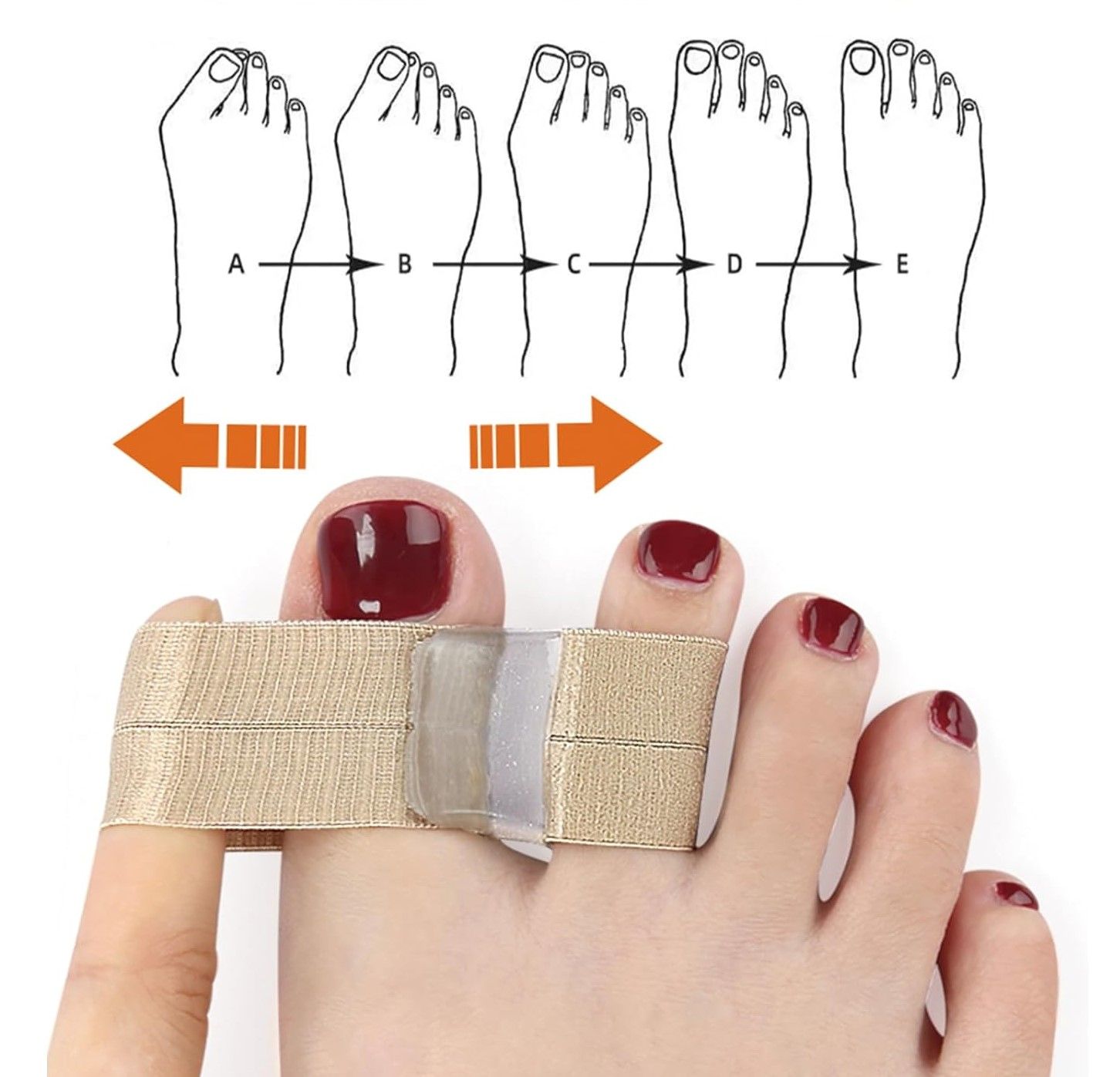Zehenspreizer mit Band. Beige Bandage mit Silikon-Zehentrenner. Nahaufnahme eines Fußes mit dem Produkt. Illustration der Zehenausrichtung.