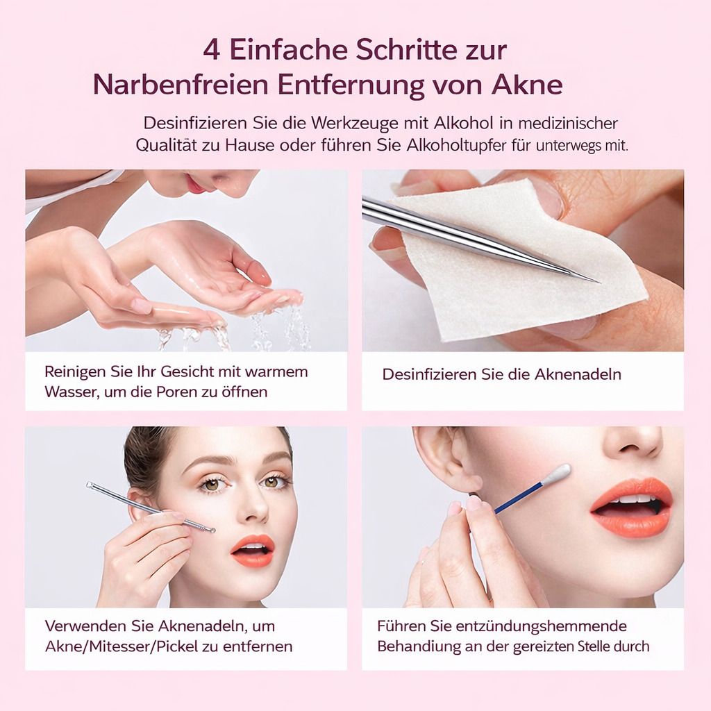 Illustration von 4 Schritten zur Akne-Entfernung. Reinigung, Desinfektion, Anwendung und entzündungshemmende Behandlung.