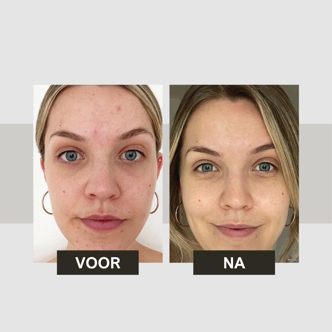 Voor-en-na vergelijking. Twee foto's van vrouwen. Links: huidonzuiverheden. Rechts: gladde huid. Gezichtstonic.