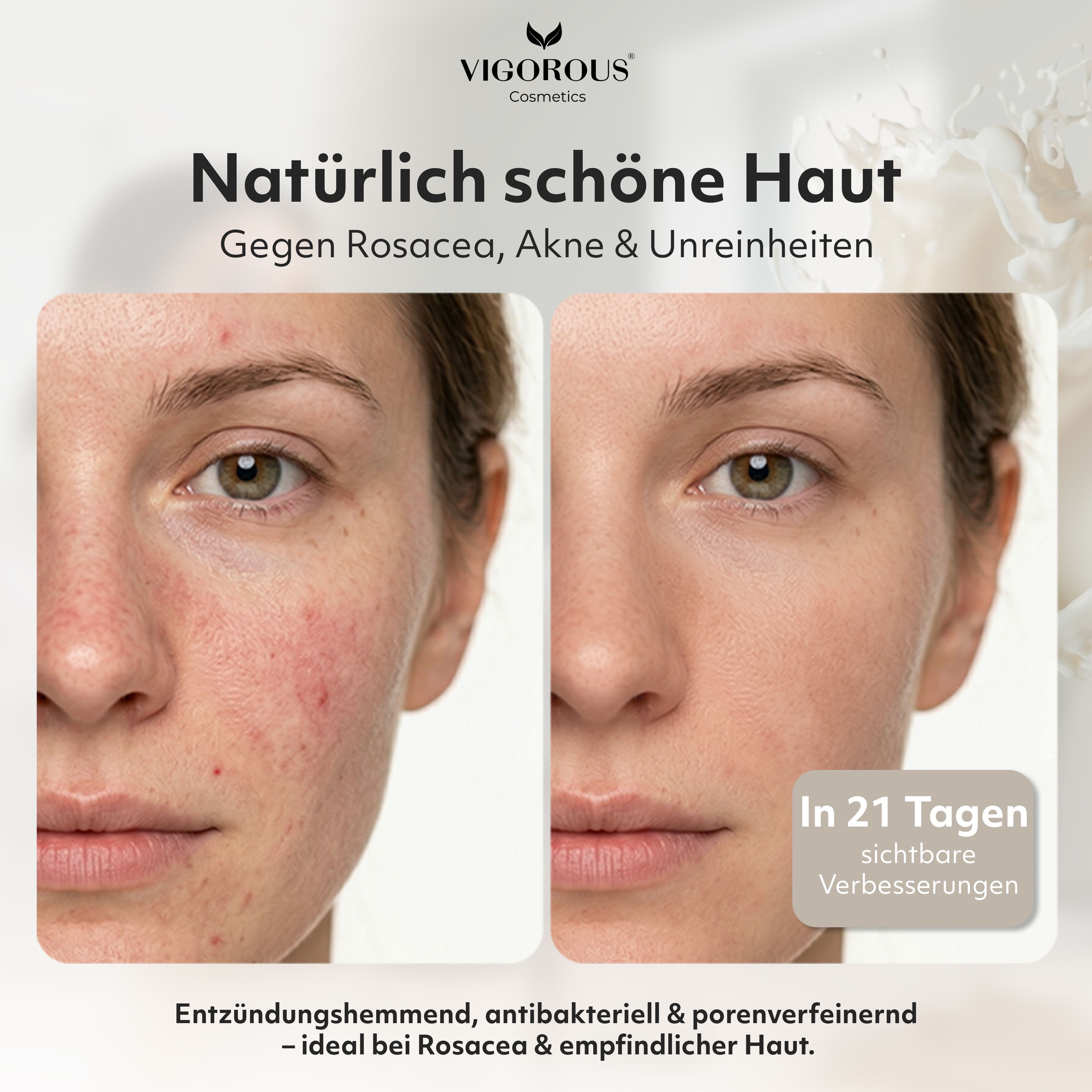 Vorher-Nachher-Vergleich. Text: Natürlich schöne Haut. Gegen Rosacea, Akne & Unreinheiten. Sichtbare Verbesserungen in 21 Tagen. VIGOROUS.