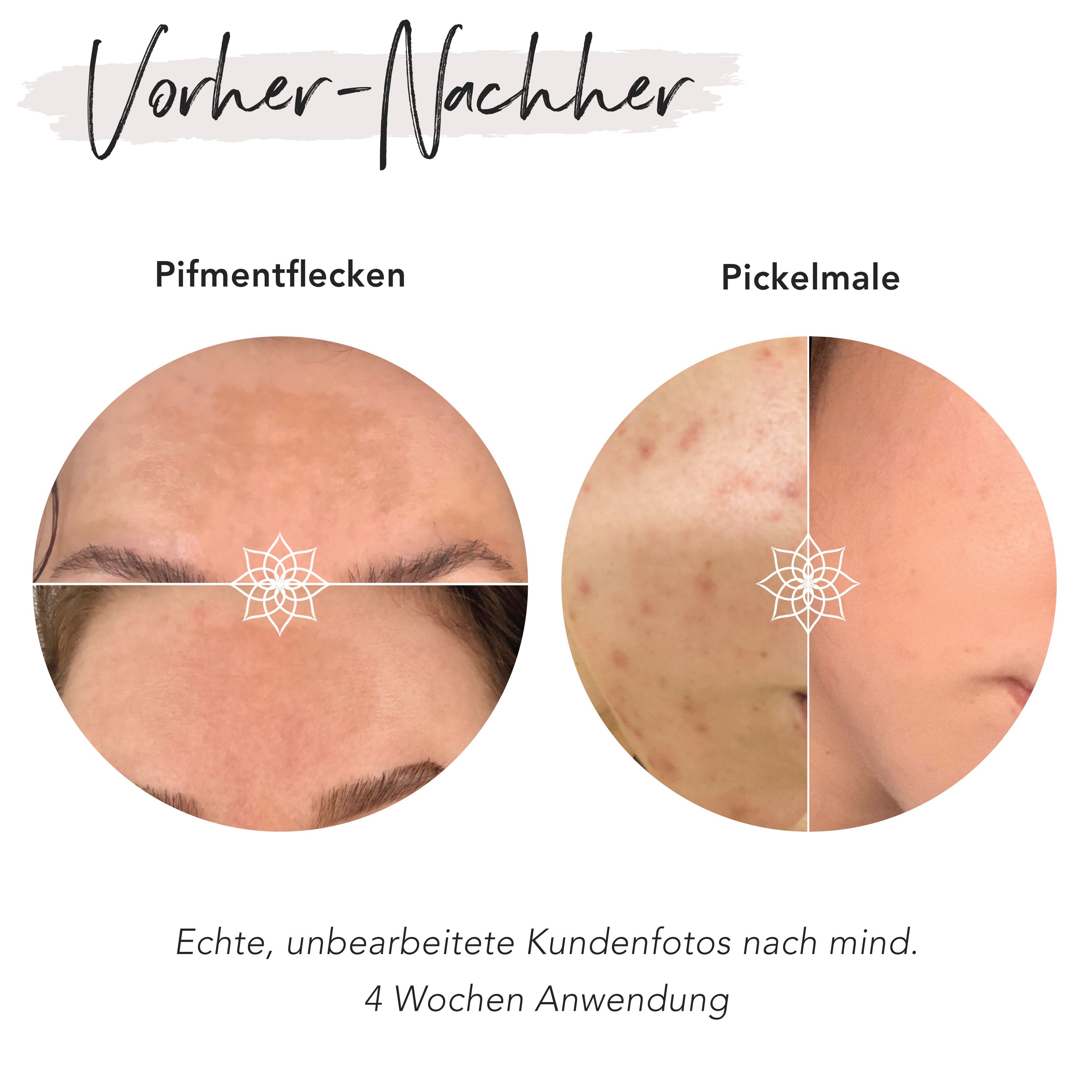 Vorher-Nachher-Vergleich. Pigmentflecken und Pickelmale. Echte Kundenfotos nach 4 Wochen Anwendung.