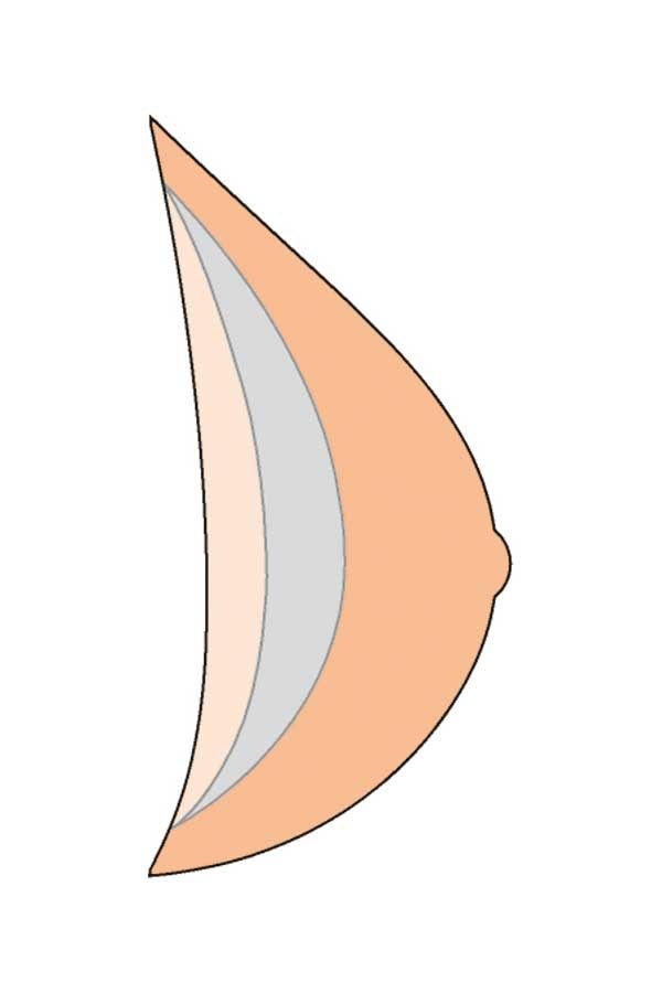 Schematische Darstellung einer Brustprothese. Dreieckige Form mit verschiedenen Schichten, haut- und graufarben.