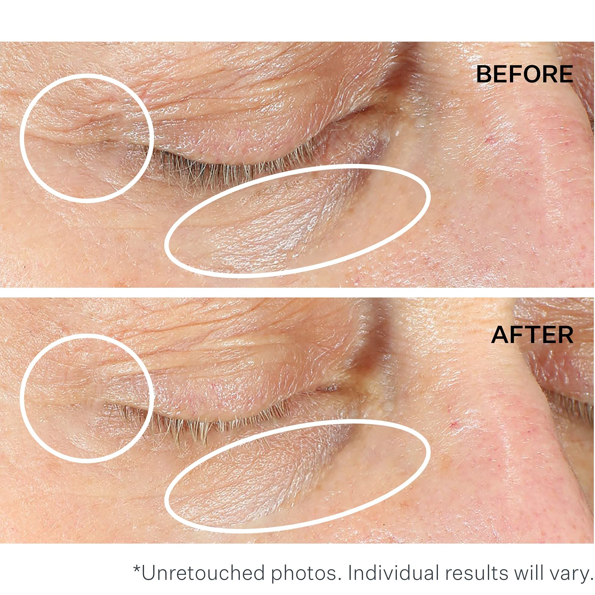 Nahaufnahme eines Auges mit Falten. Vergleich: Vorher/Nachher. Text: Unretuschierte Fotos. Ergebnisse variieren.