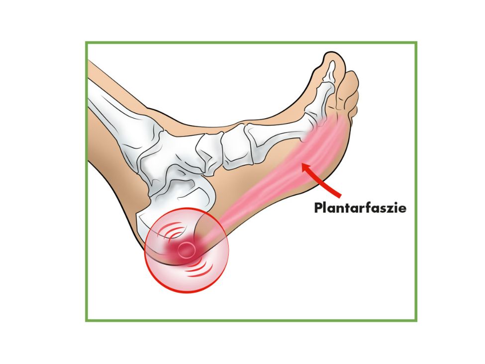 Illustration eines Fußes mit hervorgehobener Plantarfaszie. Roter Kreis markiert die Ferse. Pfeil mit Text 'Plantarfaszie'.