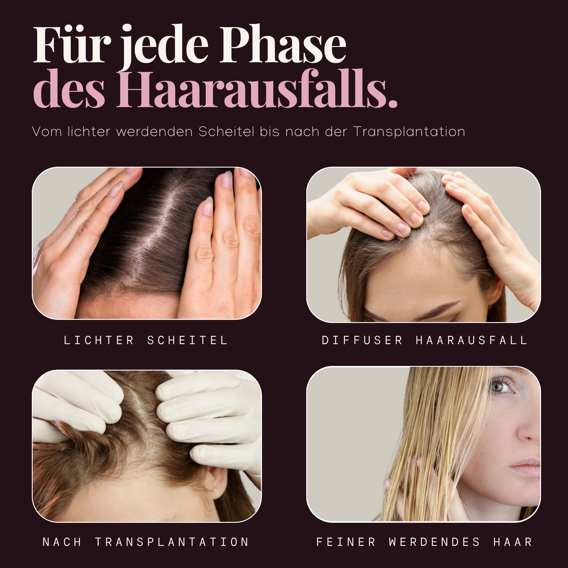 Vier Bilder zeigen verschiedene Phasen des Haarausfalls: lichter Scheitel, diffuser Haarausfall, nach Haartransplantation, feiner werdendes Haar.