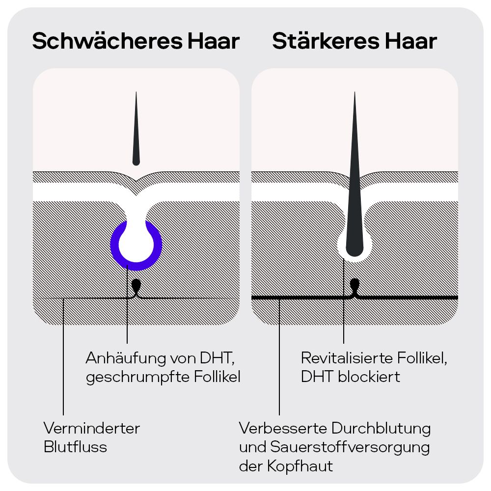Grafische Darstellung. Vergleich von schwächerem und stärkerem Haar. Beschriftungen: DHT, Blutfluss, revitalisierte Follikel.