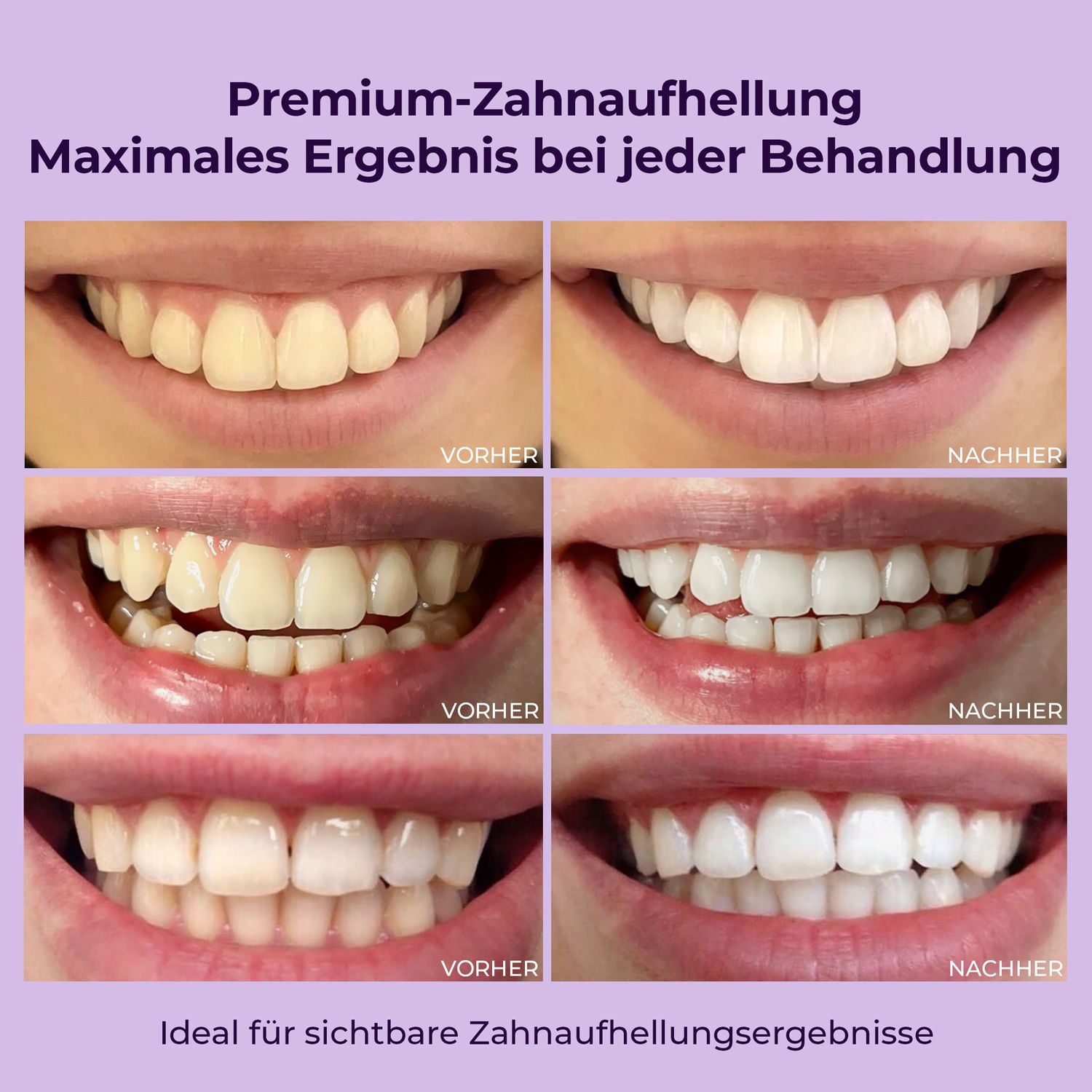 Vorher-Nachher-Vergleich von Zähnen. Gezeigt werden verschiedene Zahnaufhellungsergebnisse. Ideal für sichtbare Ergebnisse.