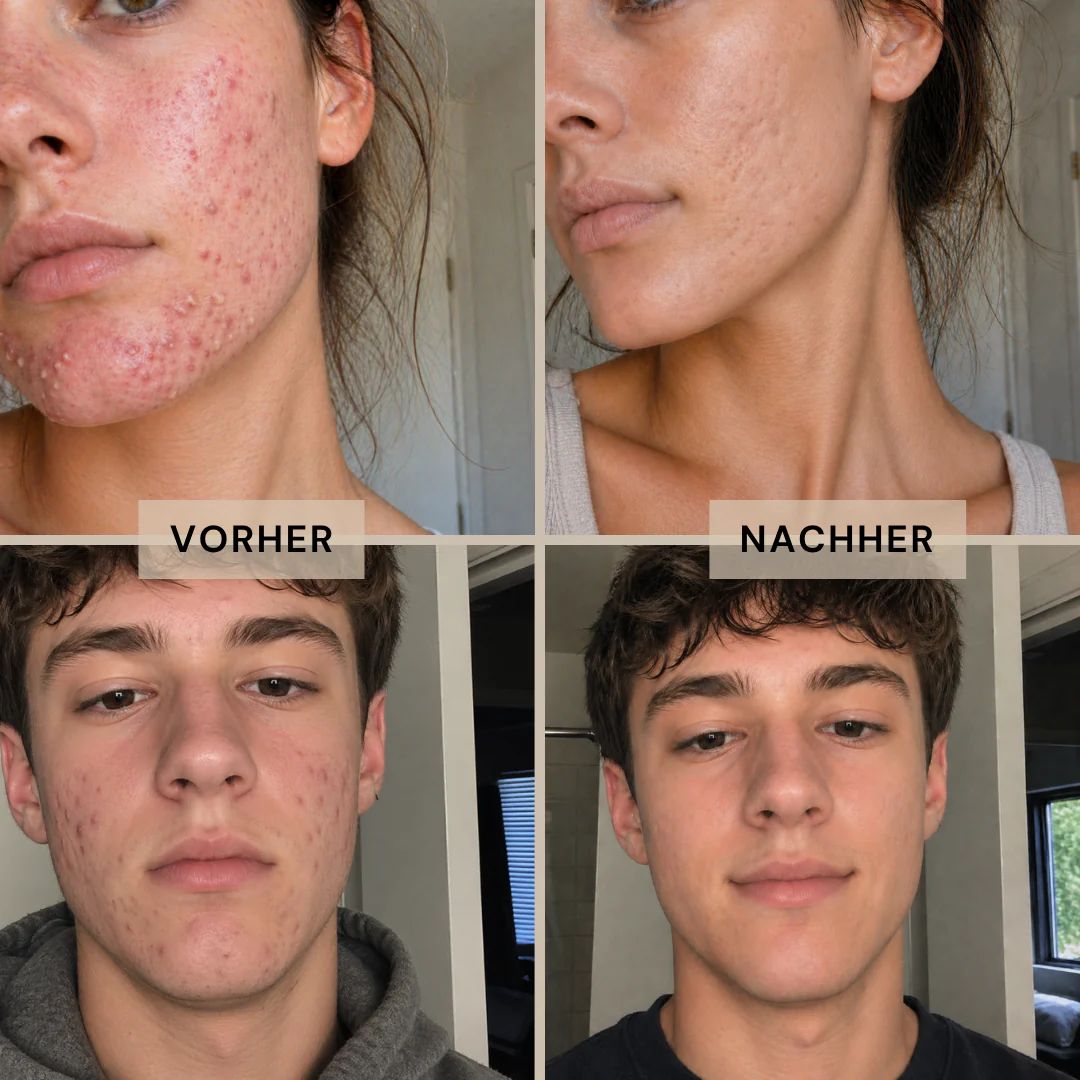 Vorher-Nachher-Vergleich von Akne bei zwei Personen.