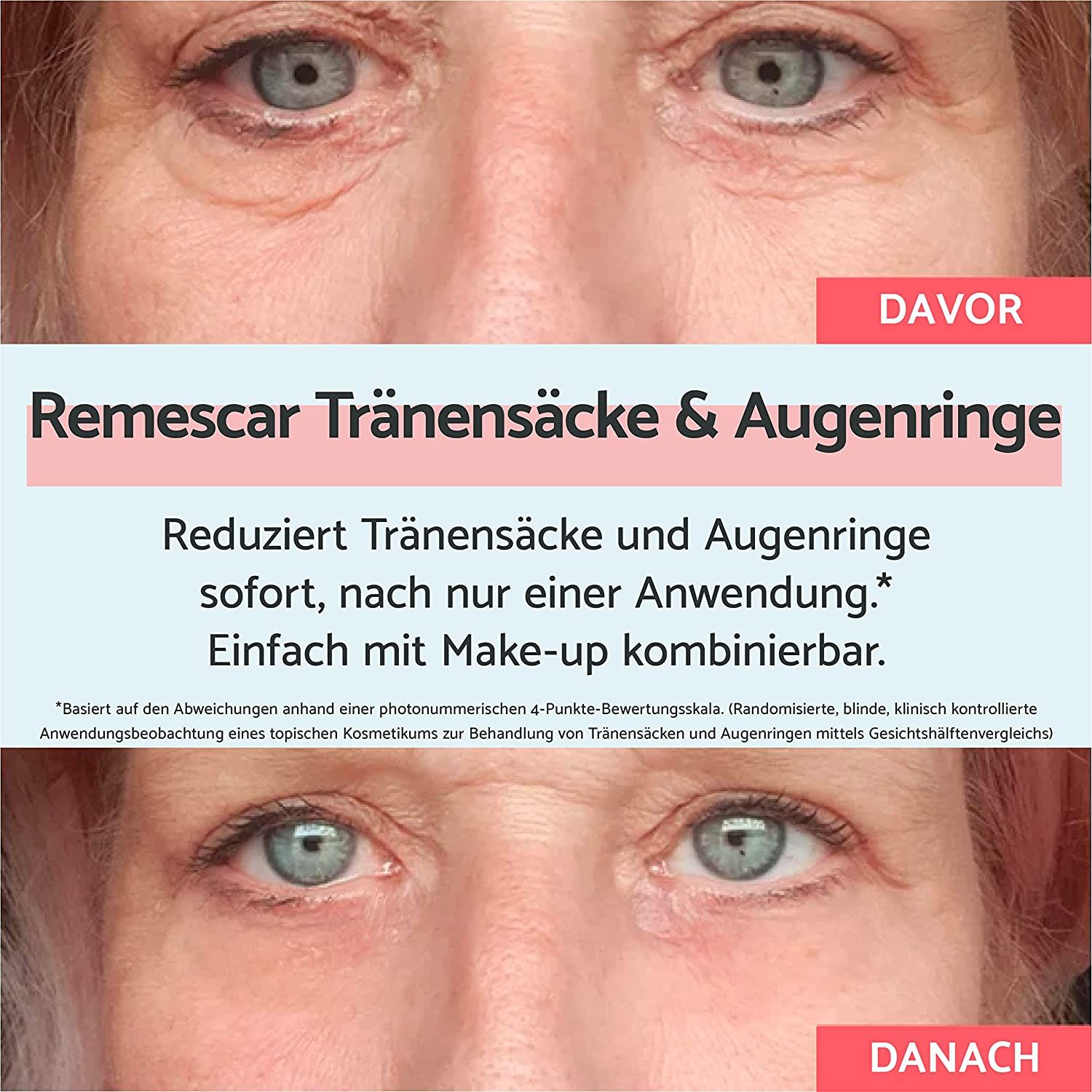 Vorher-Nachher-Bild von Augen. Text: "Remescar Tränensäcke & Augenringe". Reduziert Tränensäcke und Augenringe sofort.