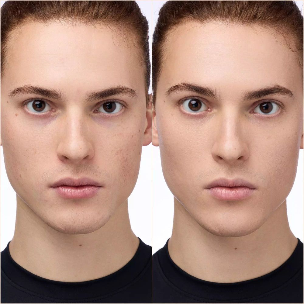 Vorher-Nachher-Bild eines Mannes. Links: Hautunreinheiten. Rechts: ebenmäßiger Teint.