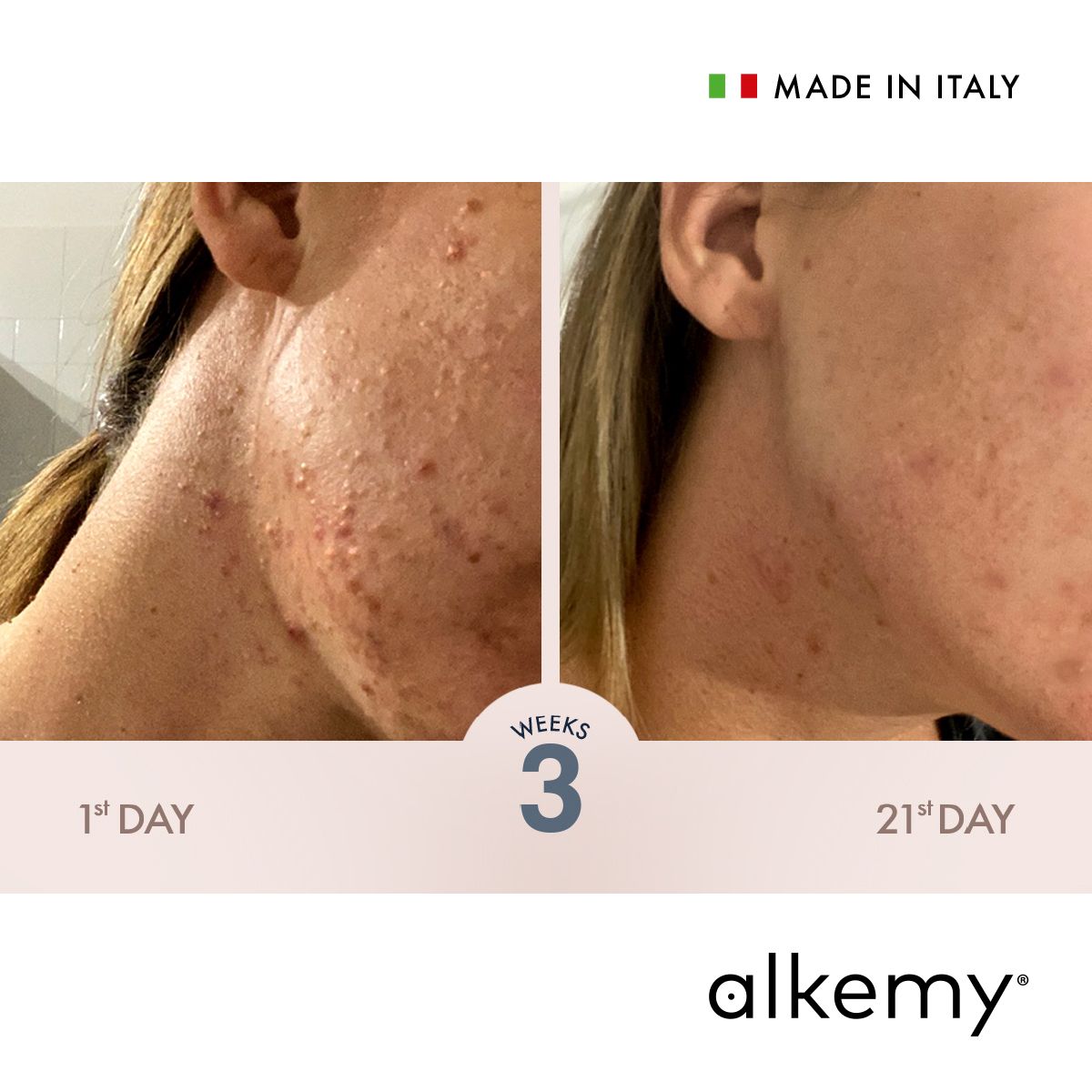Alkemy Creme gegen Pickel, Anti Akne Behandlung, Reduziert Pickel, Unreinheiten und Rötungen